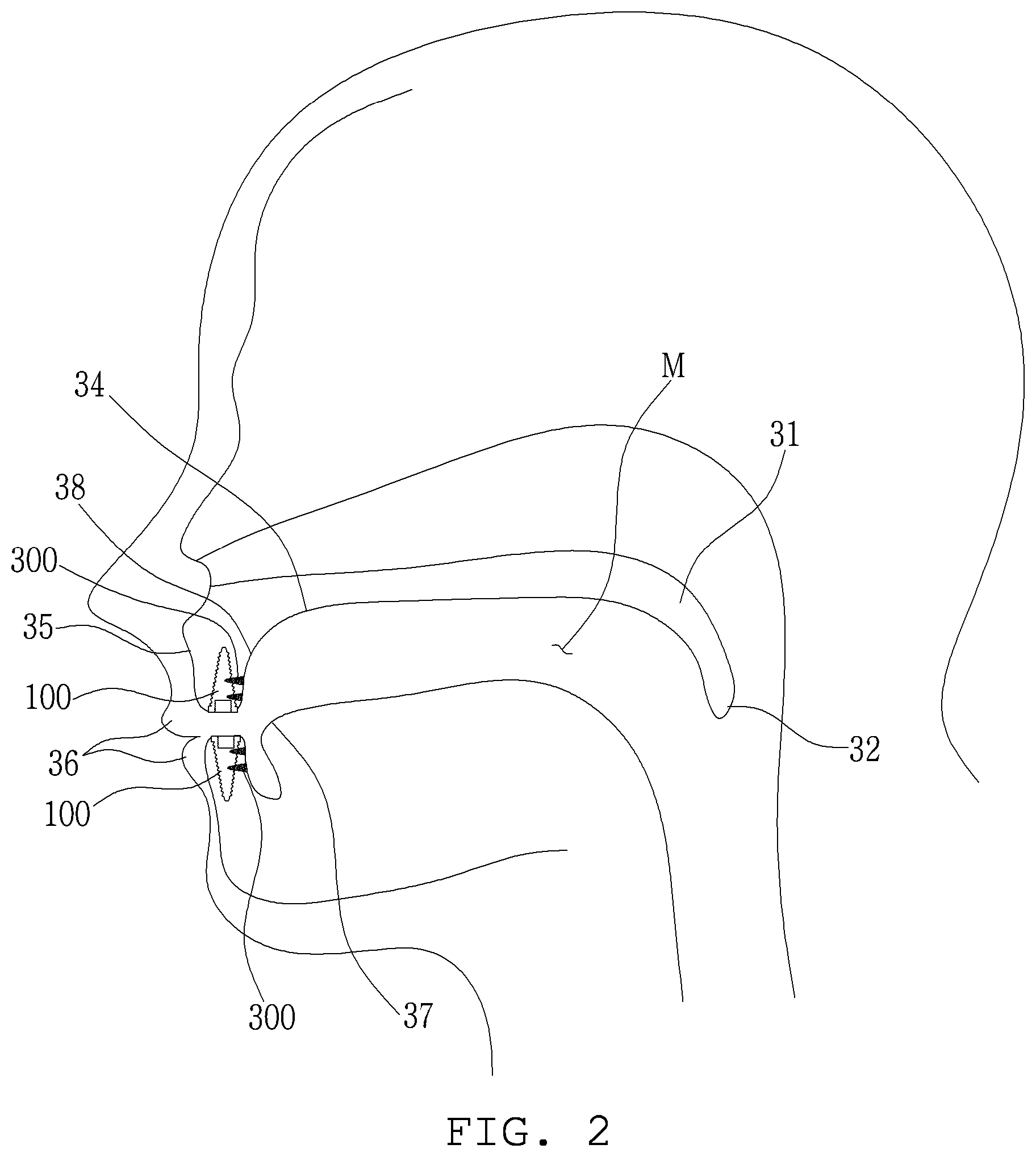 Patent US12303350 Figure 2 – Lateral wall supported implant system with supporting screw surgical guide