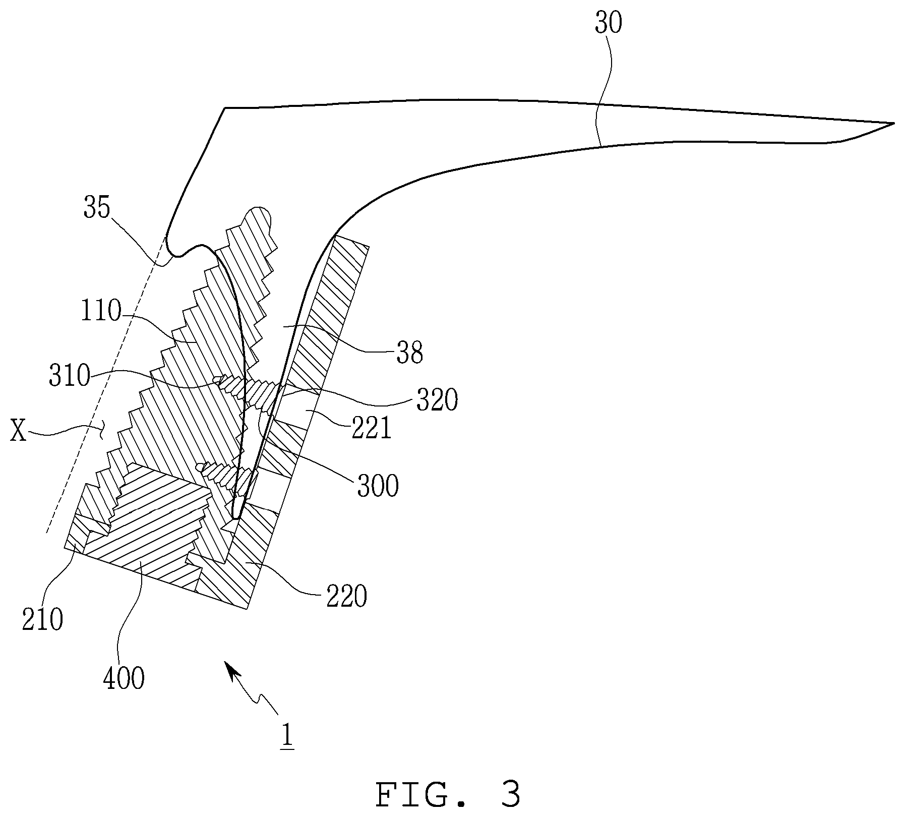 Patent US12303350 Figure 3 – Lateral wall supported implant system with supporting screw surgical guide