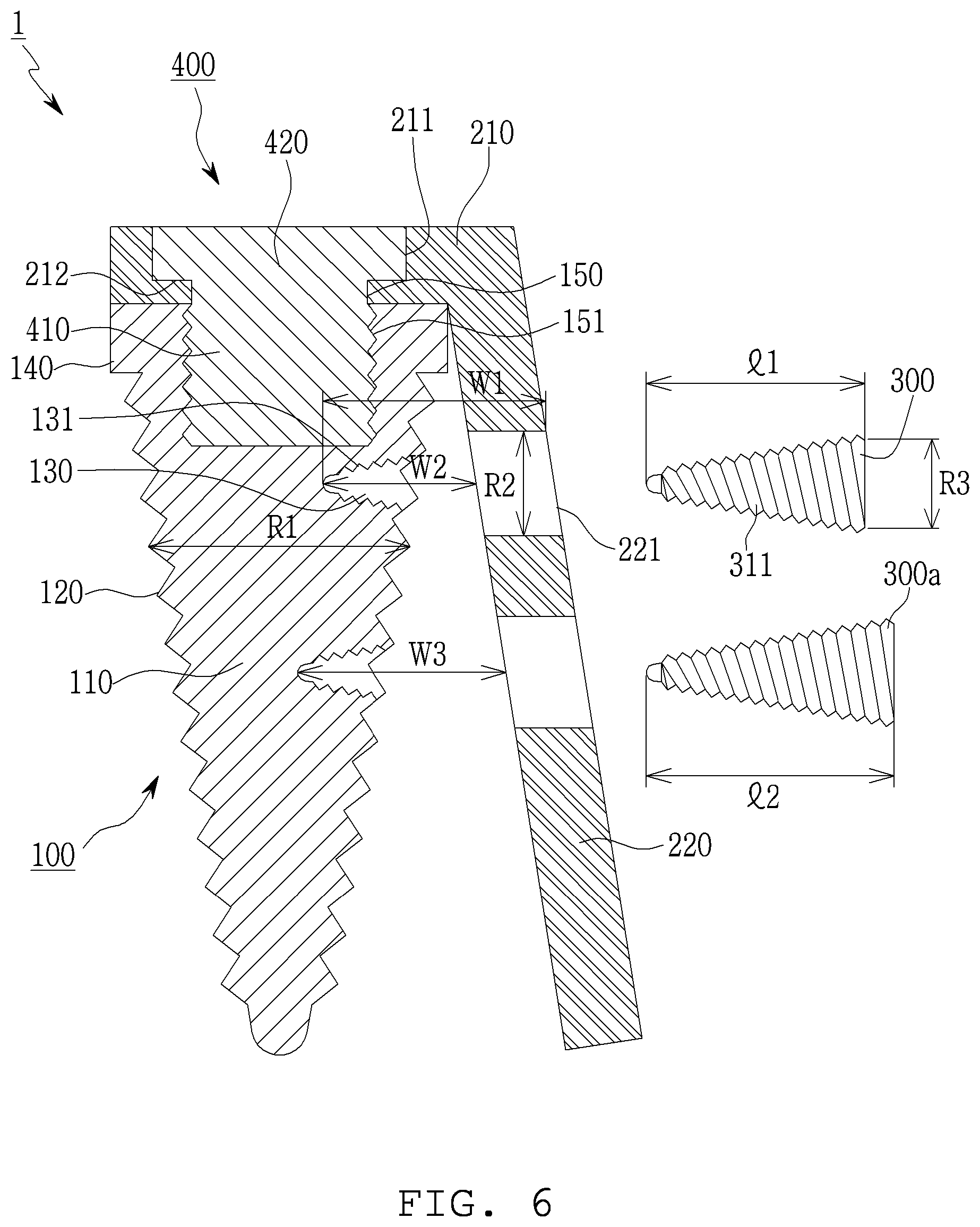 Patent US12303350 Figure 6 – Lateral wall supported implant system with supporting screw surgical guide