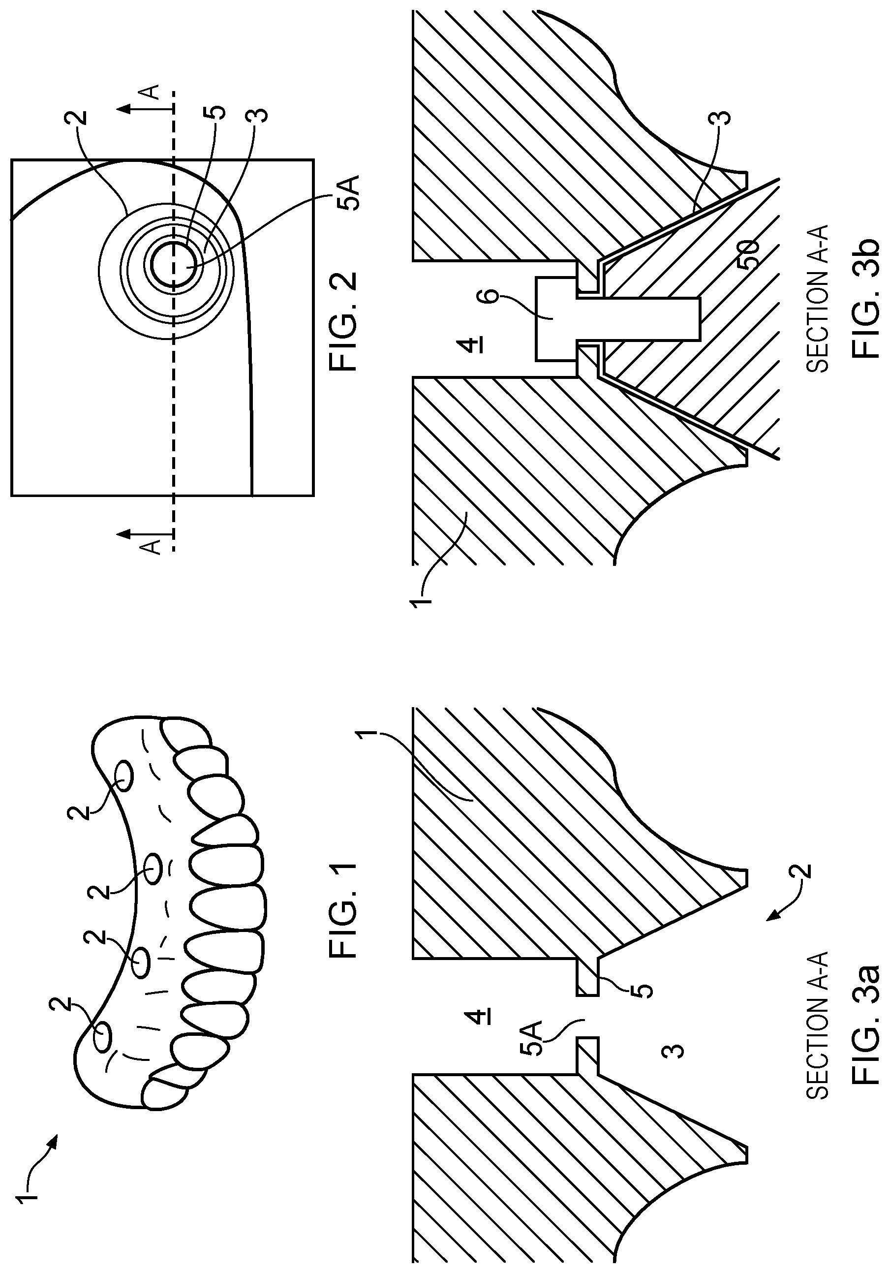 Patent US12303351 Figure 1 – Dental prosthesis