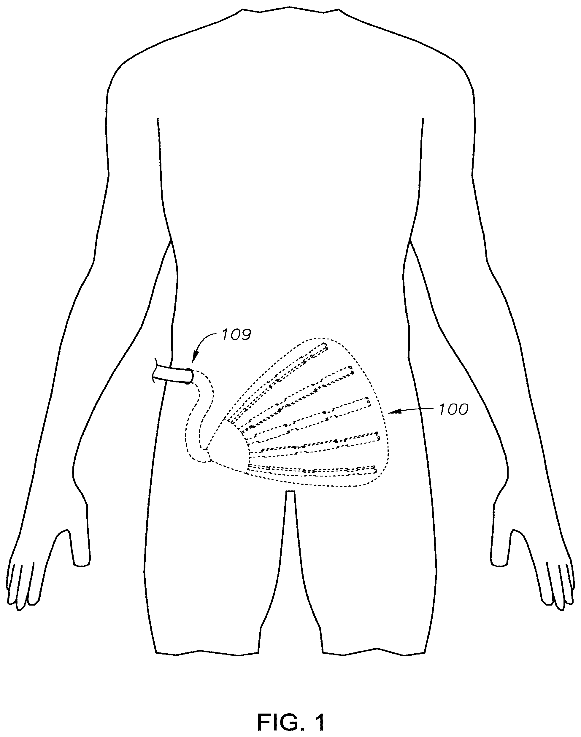 Patent US12303356 Figure 1 – Apparatuses and methods for improving post-operative recovery from surgery
