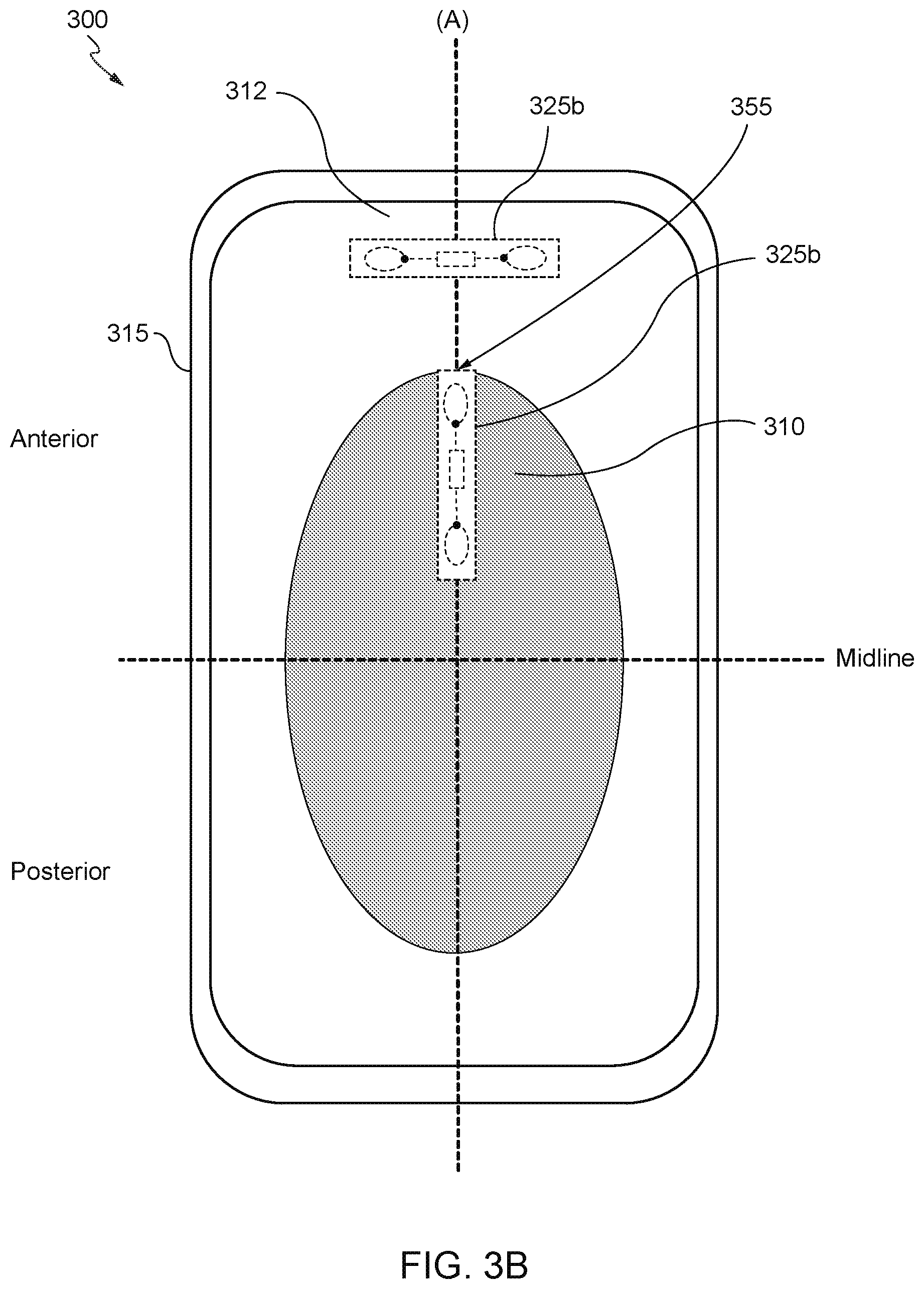 Patent US12303362 Figure 4 – Internet of things (IoT) solution for management of urinary incontinence