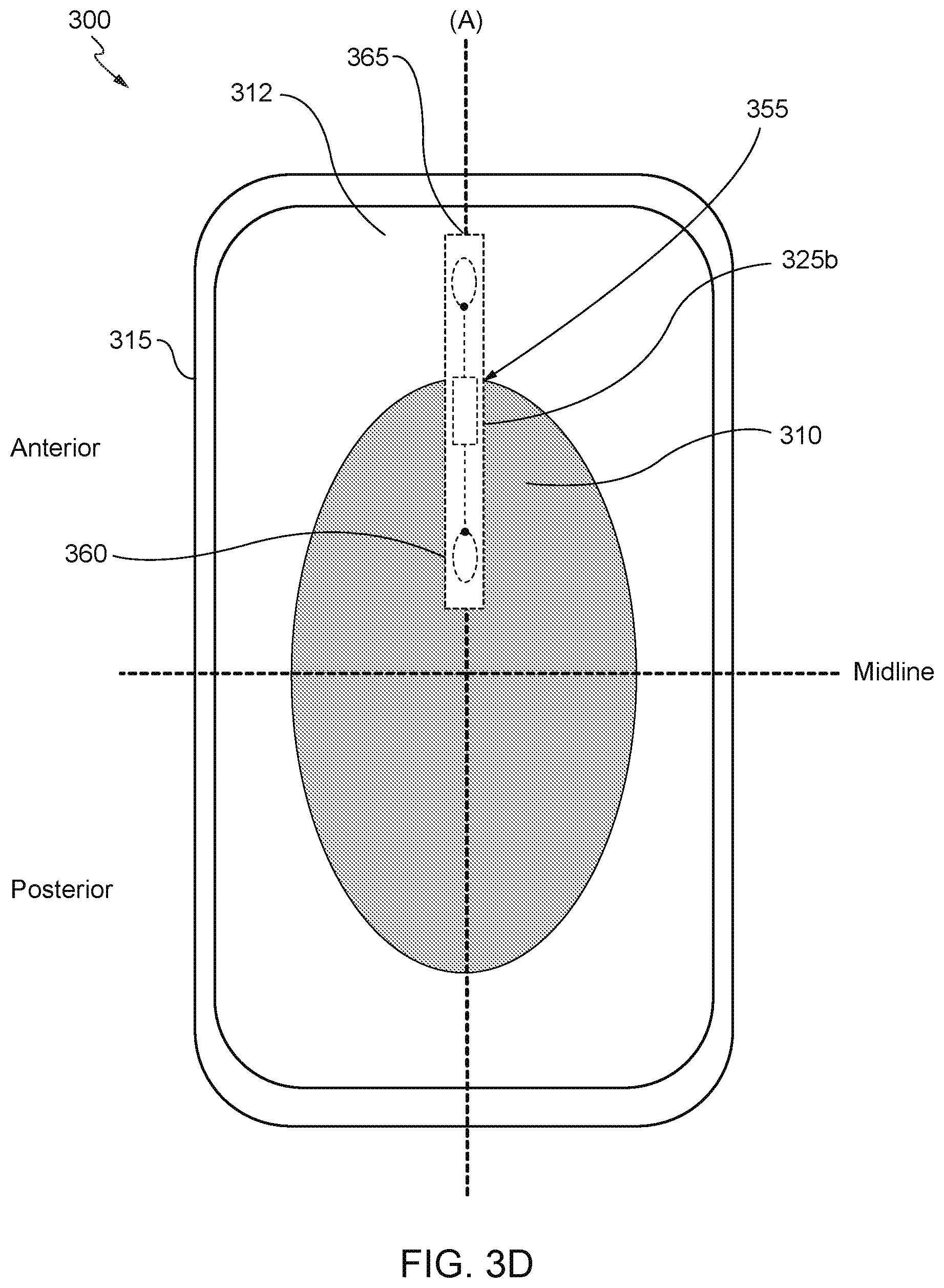 Patent US12303362 Figure 6 – Internet of things (IoT) solution for management of urinary incontinence