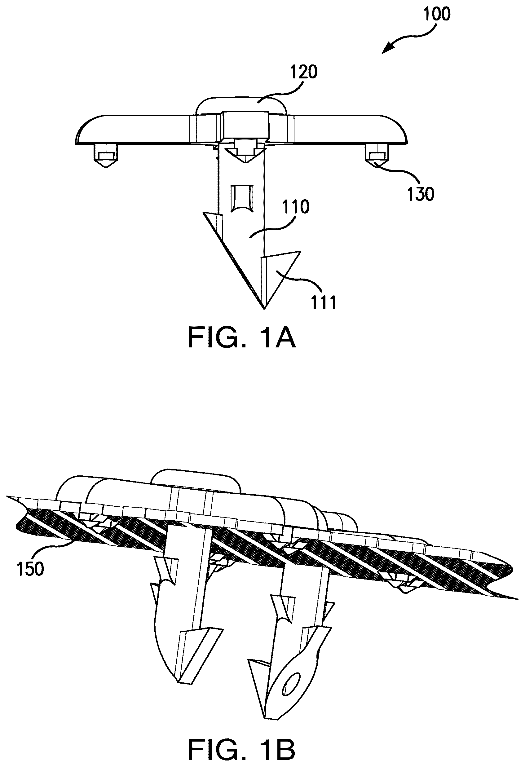 Patent US12303373 — Systems and methods for mesh augmentation and prevention of incisional hernia — Figure 1
