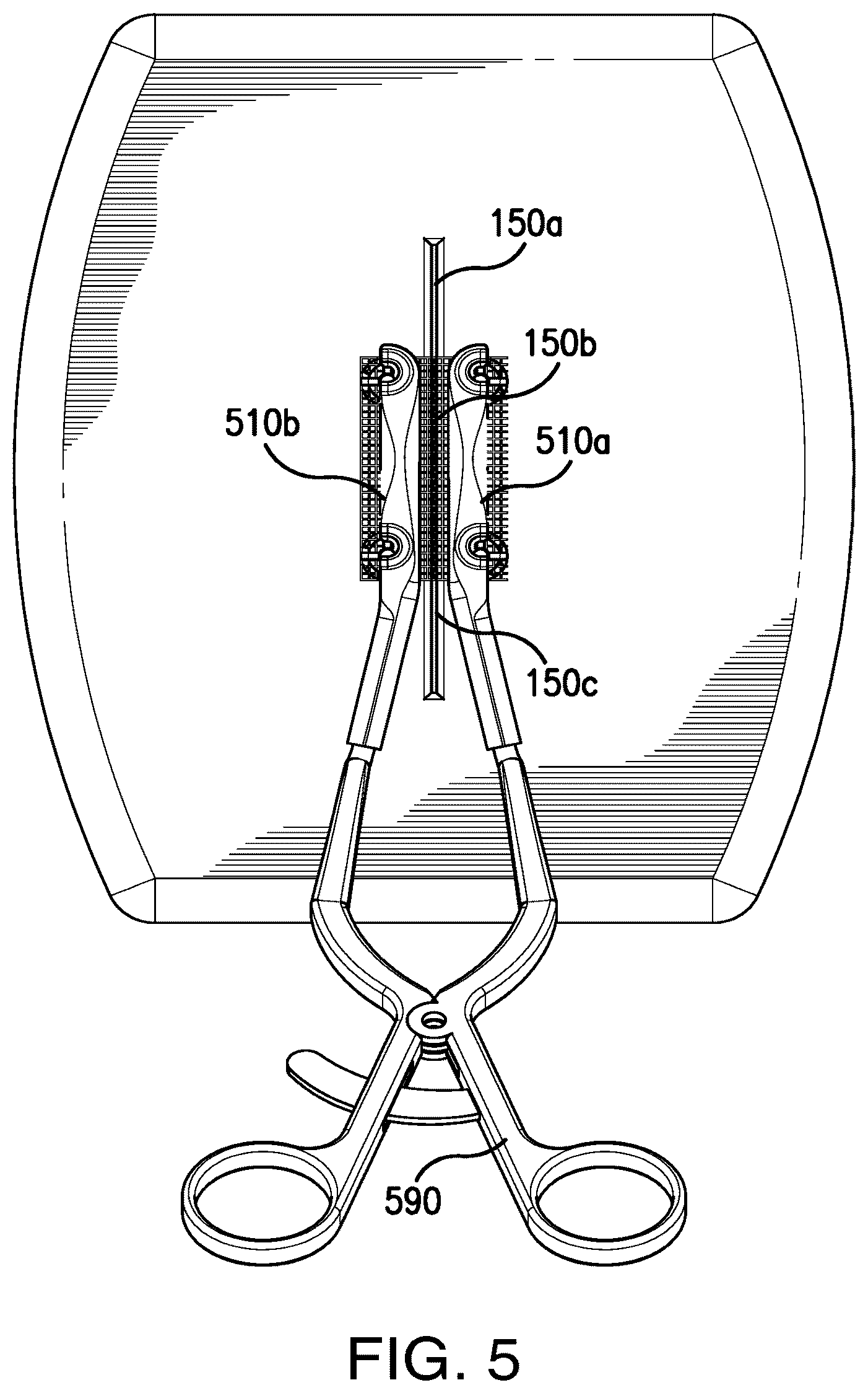 Patent US12303373 Figure 7 – Systems and methods for mesh augmentation and prevention of incisional hernia