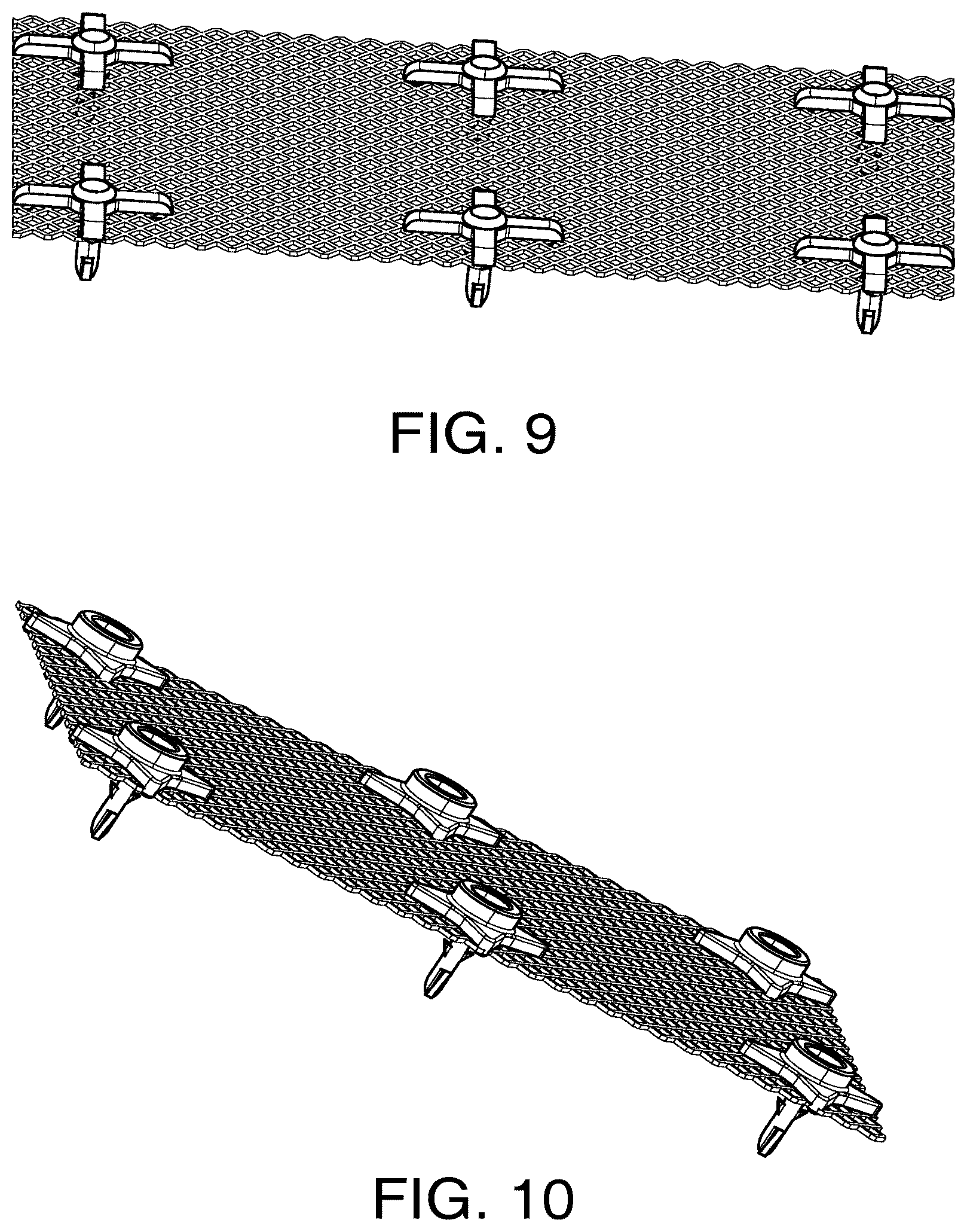 Patent US12303373 Figure 10 – Systems and methods for mesh augmentation and prevention of incisional hernia