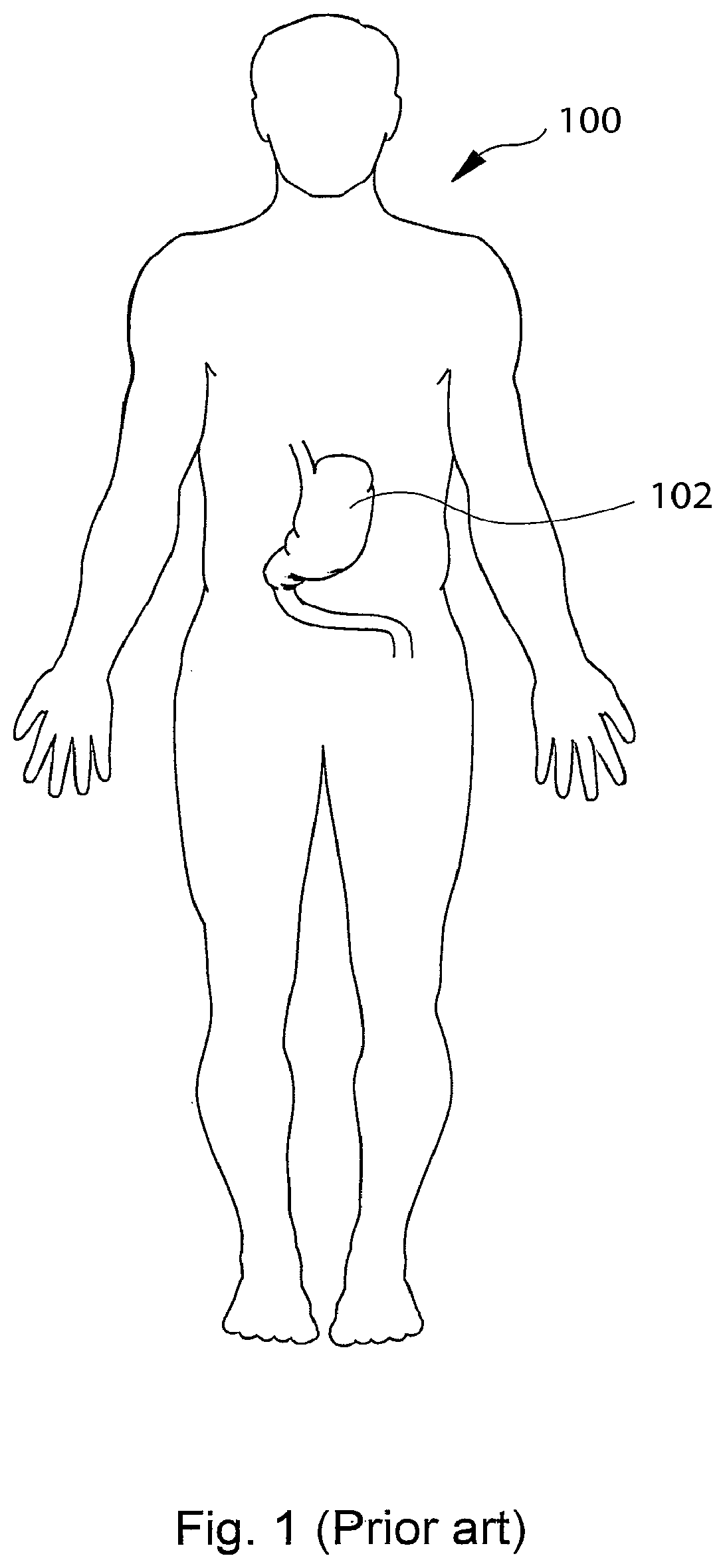 Patent US12303375 Figure 1 – Artificial stomach
