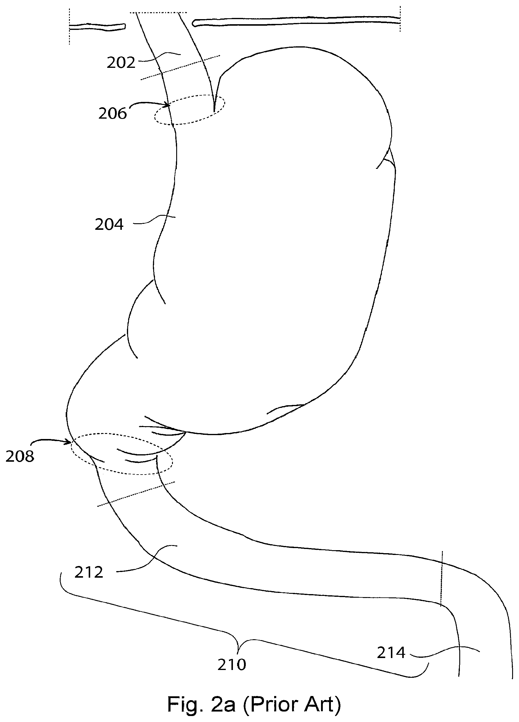 Patent US12303375 Figure 2 – Artificial stomach