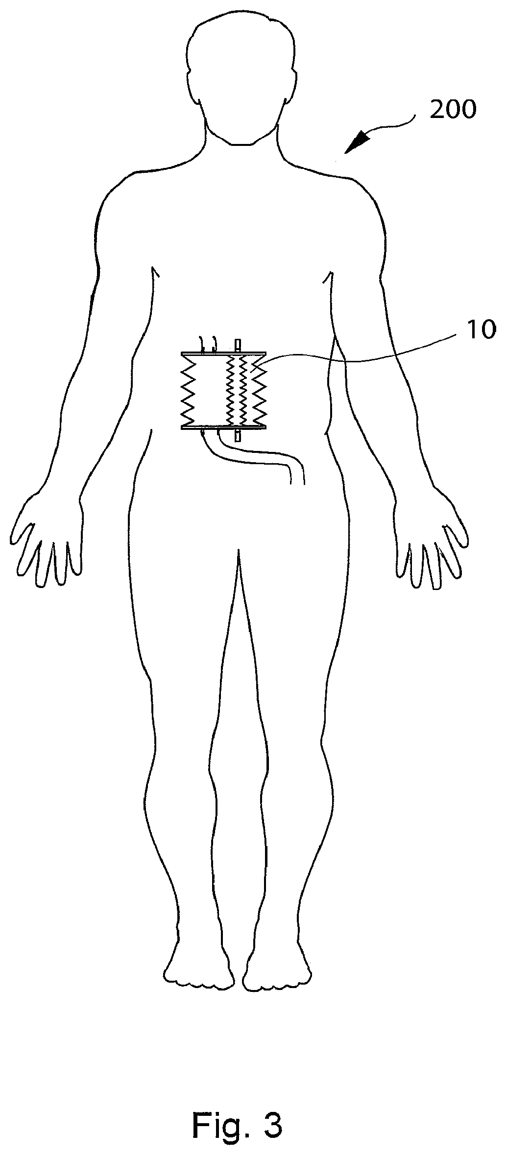 Patent US12303375 Figure 4 – Artificial stomach