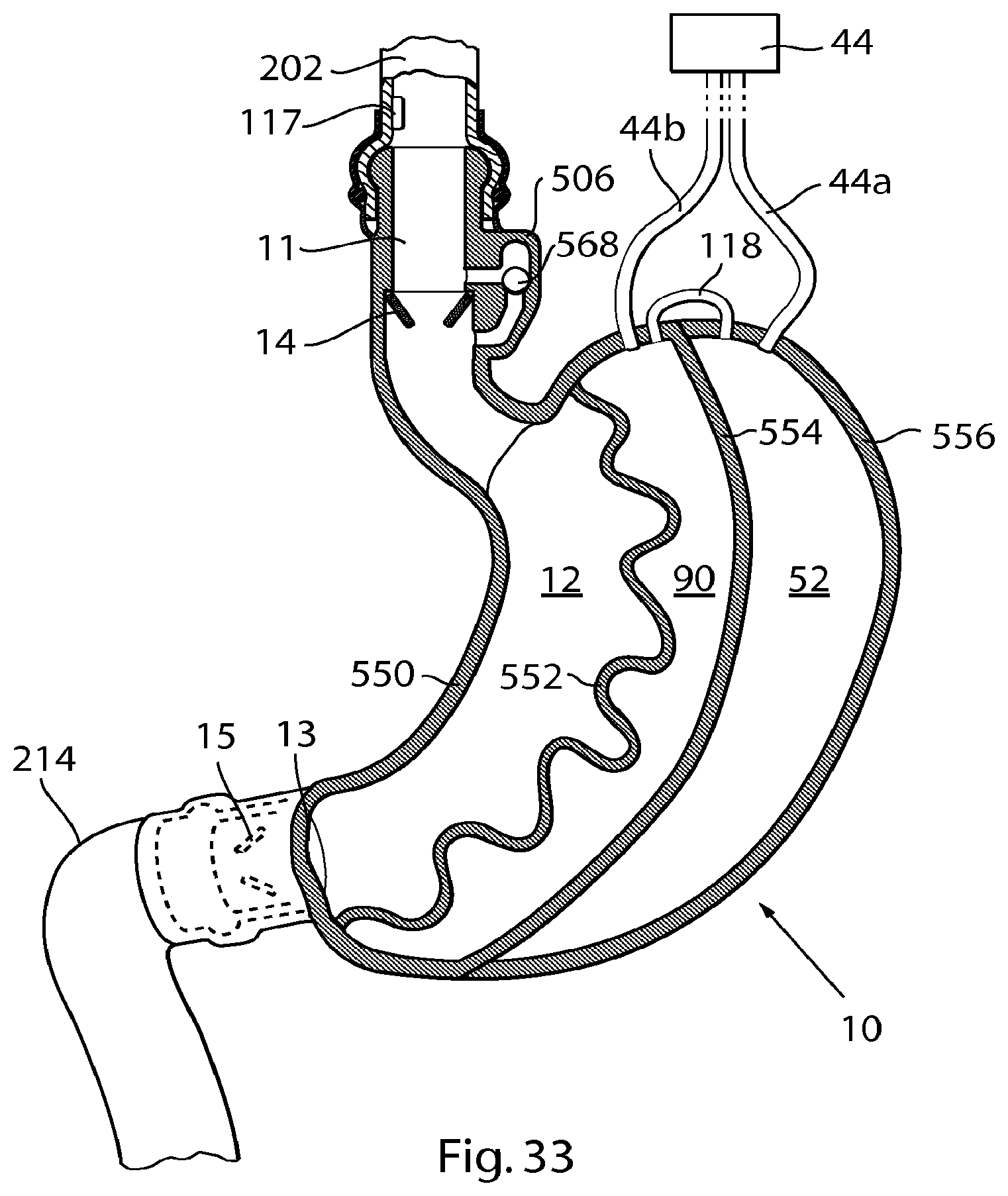 Patent US12303375 Figure 17 – Artificial stomach