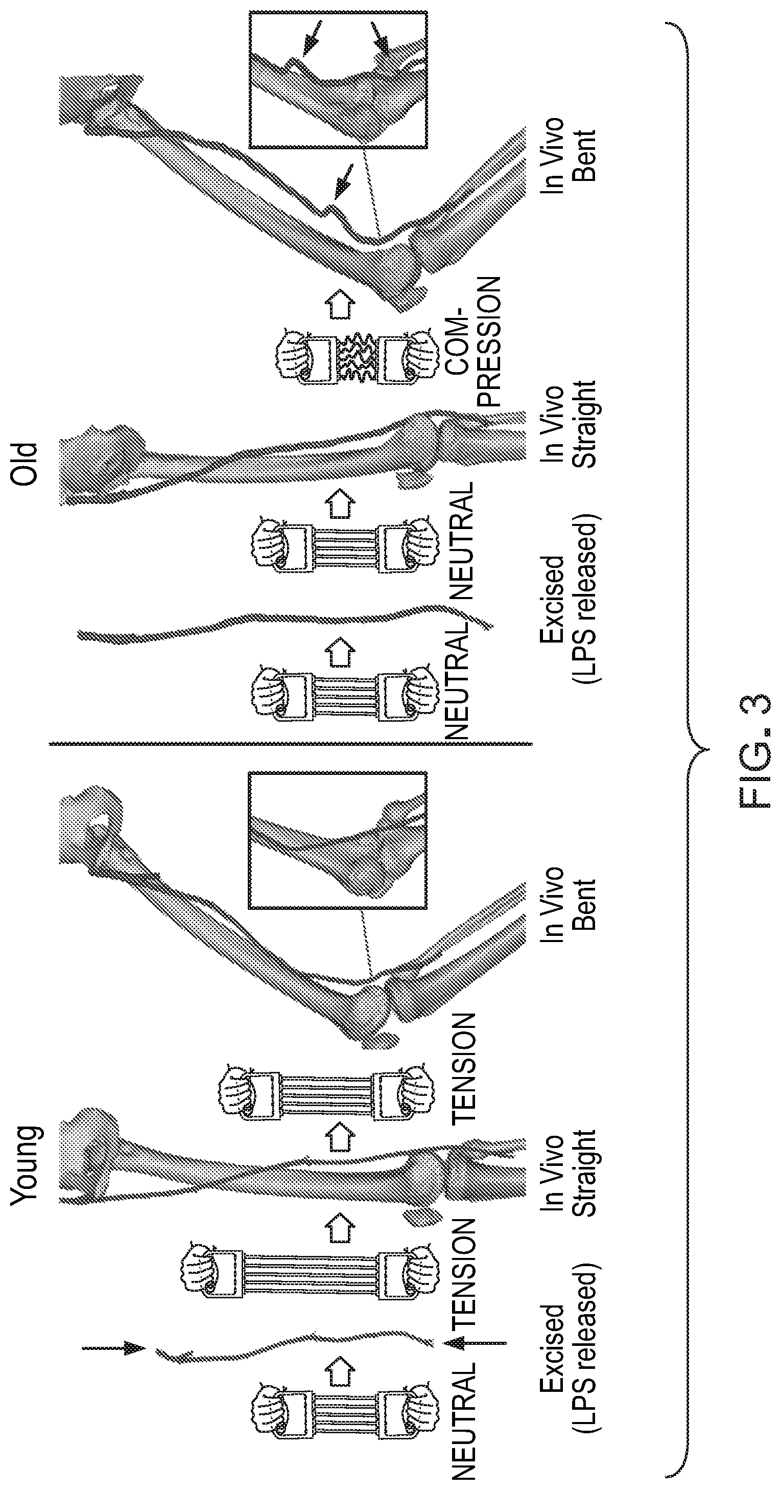 Patent US12303376 Figure 3 – Bypass graft