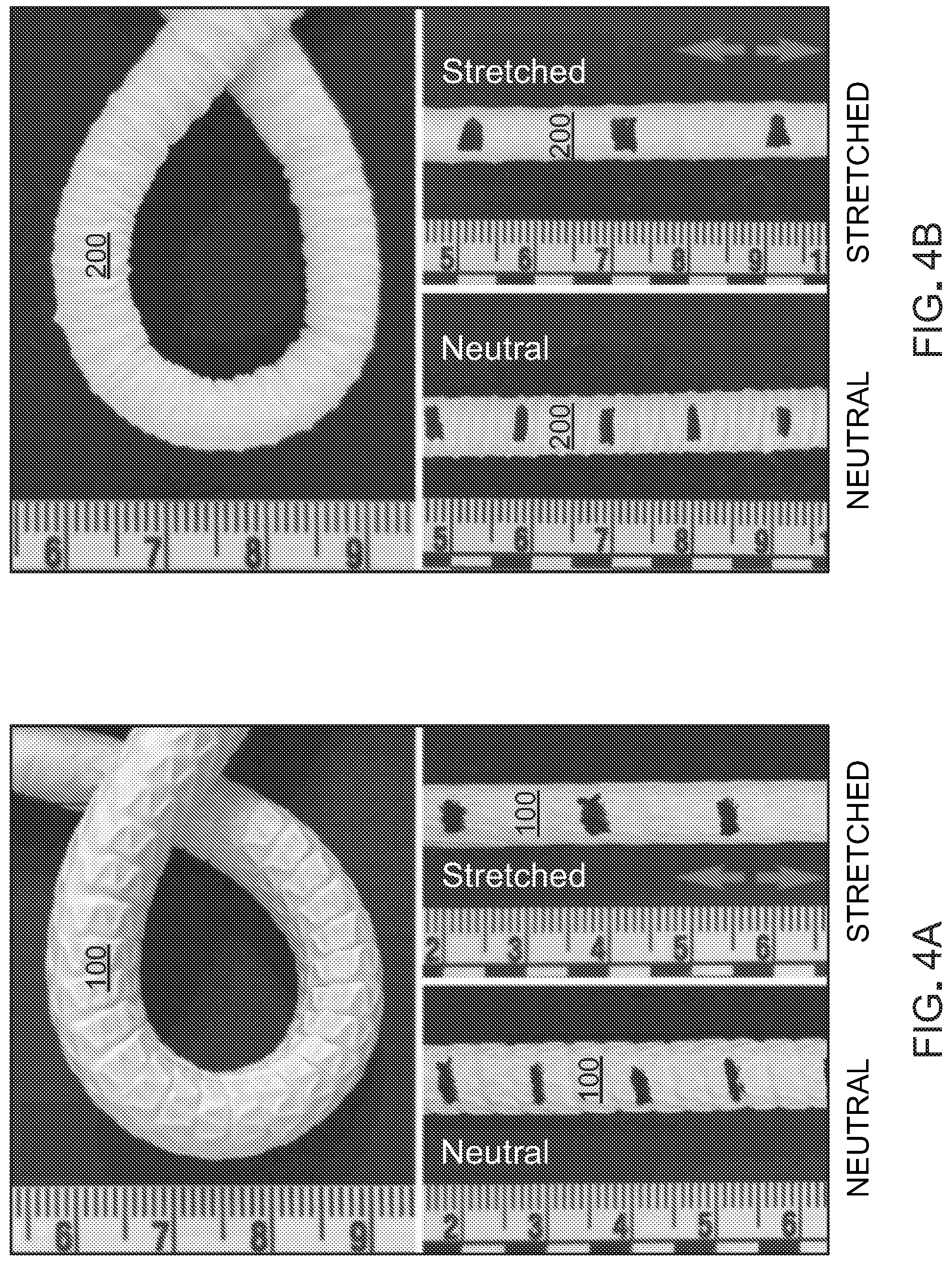 Patent US12303376 Figure 4 – Bypass graft