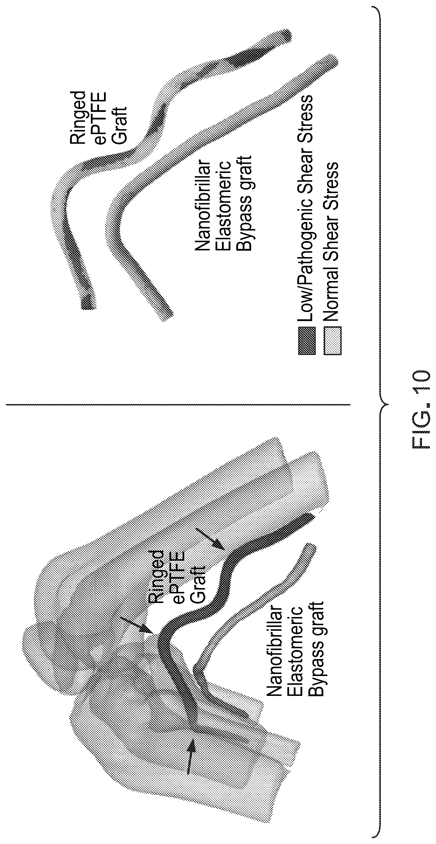 Patent US12303376 Figure 11 – Bypass graft
