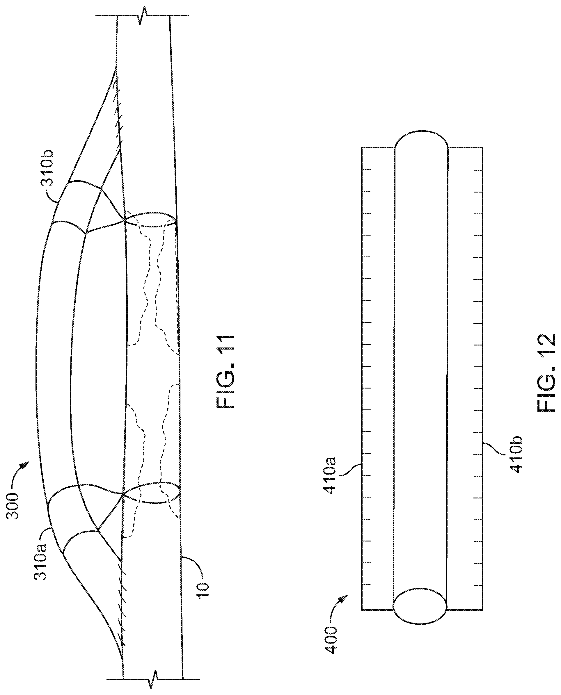 Patent US12303376 Figure 12 – Bypass graft