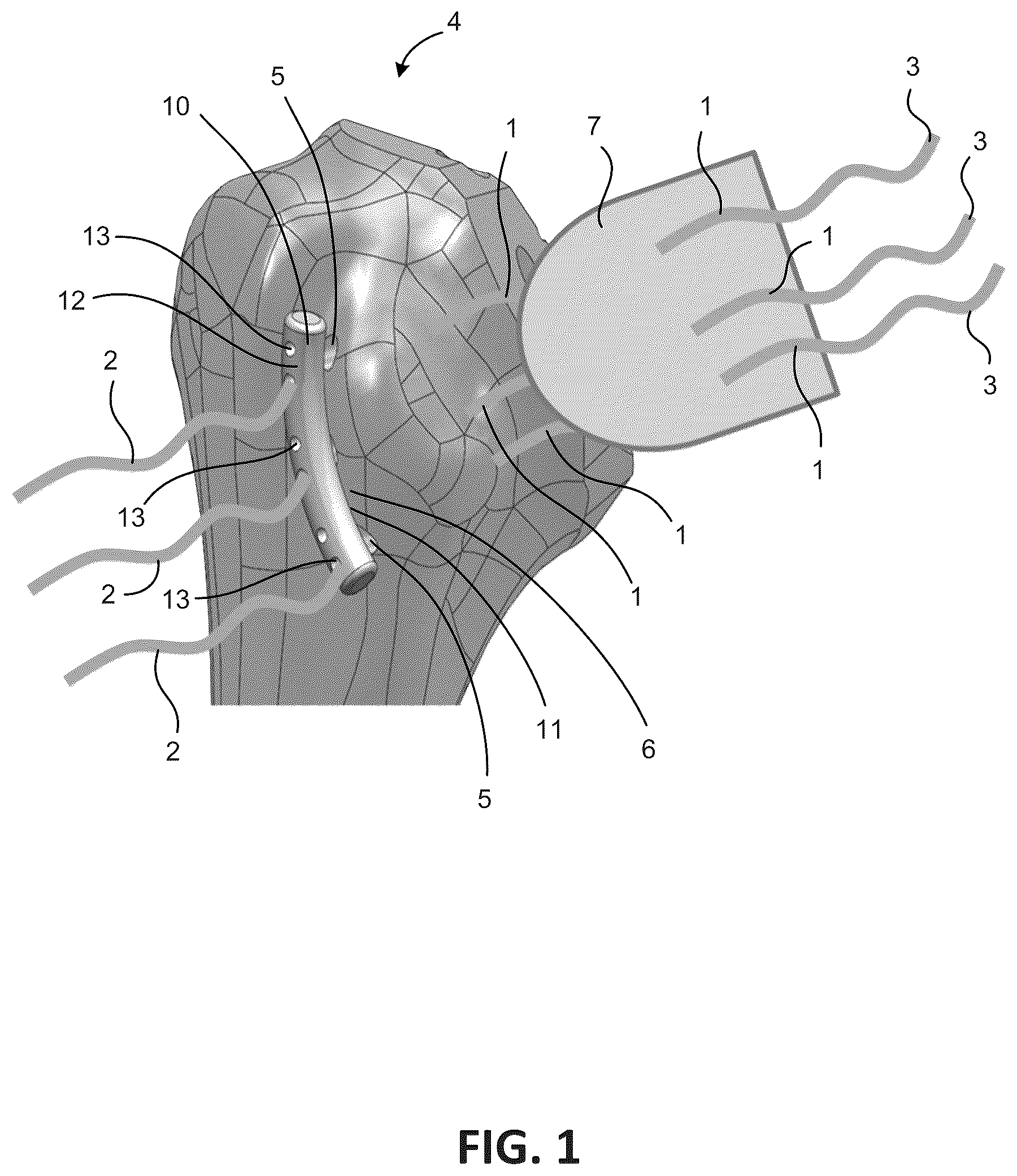 Patent US12303378 Figure 1 – Tendon repair system