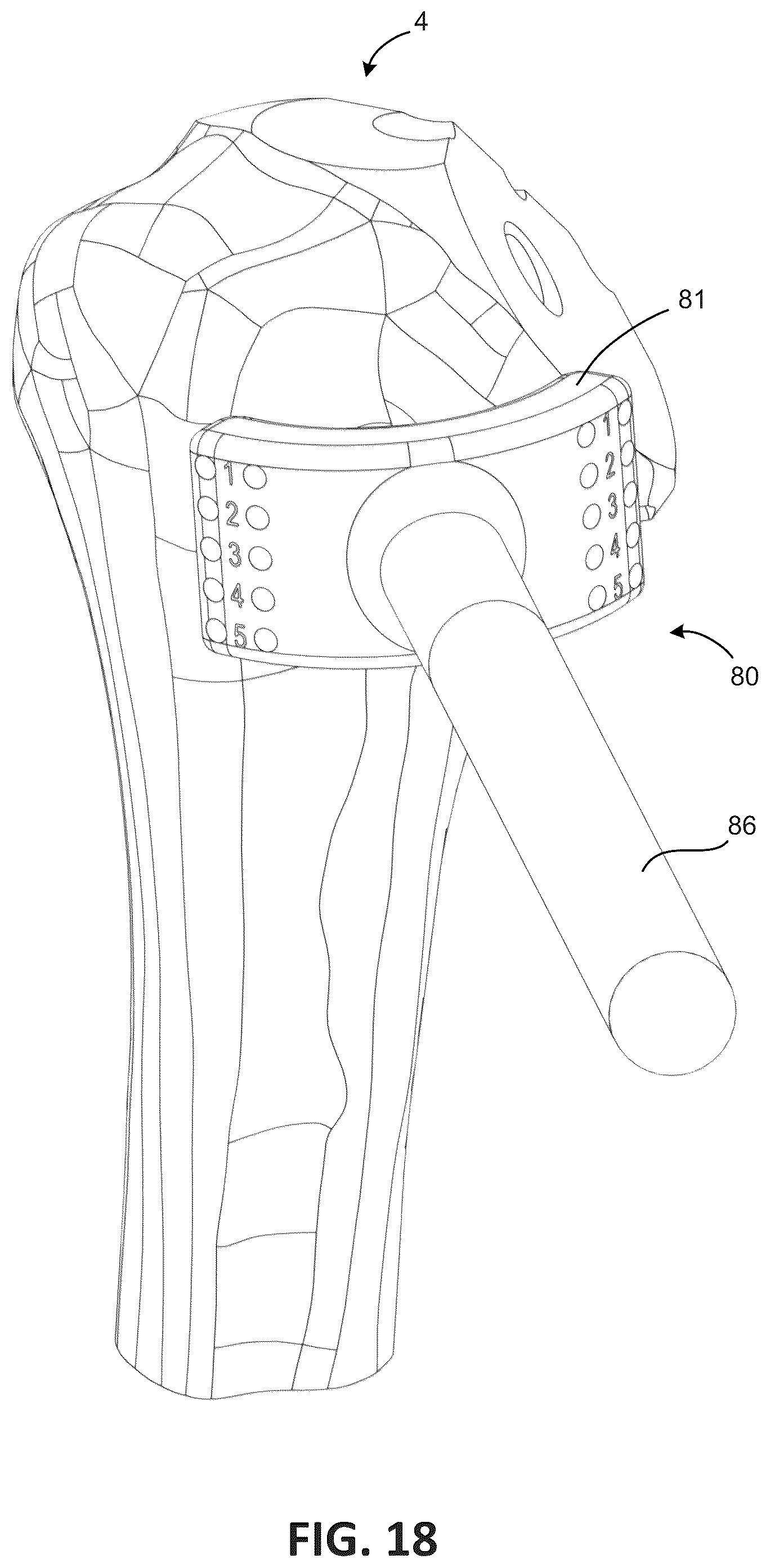 Patent US12303378 Figure 16 – Tendon repair system
