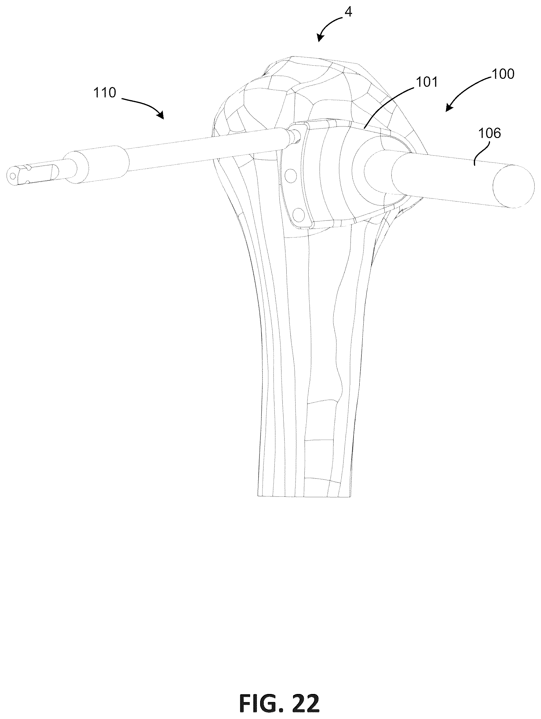 Patent US12303378 Figure 20 – Tendon repair system