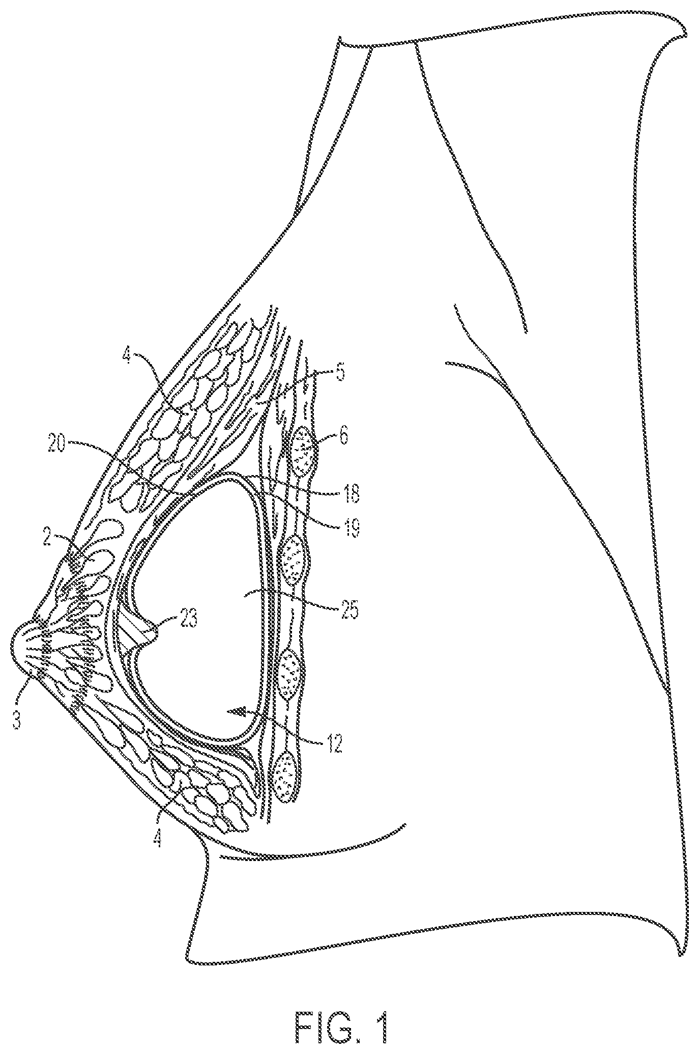 Patent US12303379 — Implant with elastomeric membrane and methods of fabrication thereof — Figure 1