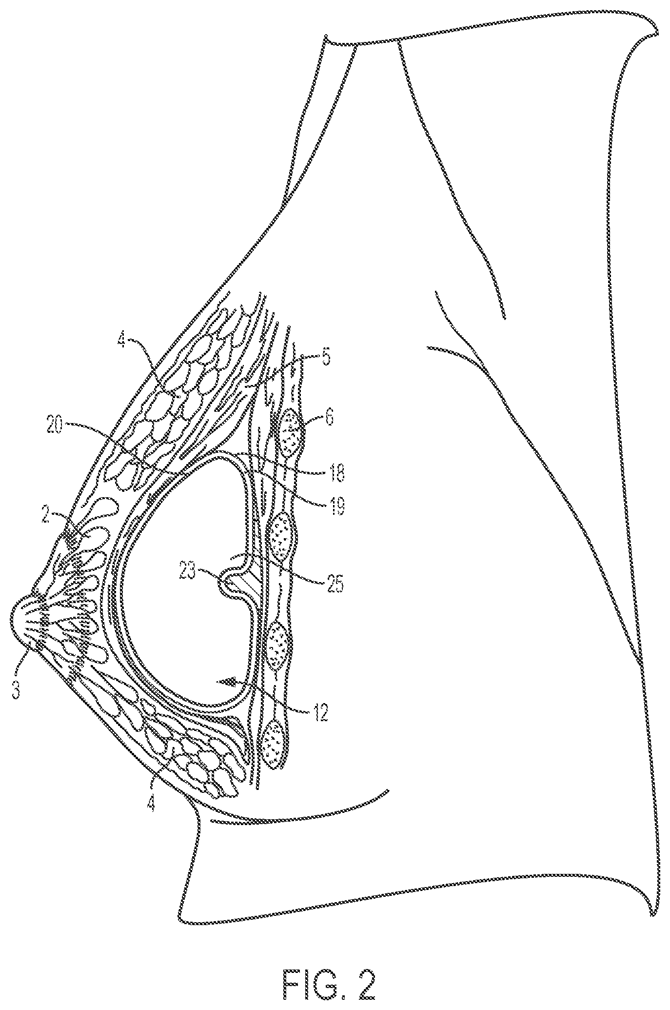 Patent US12303379 Figure 2 – Implant with elastomeric membrane and methods of fabrication thereof