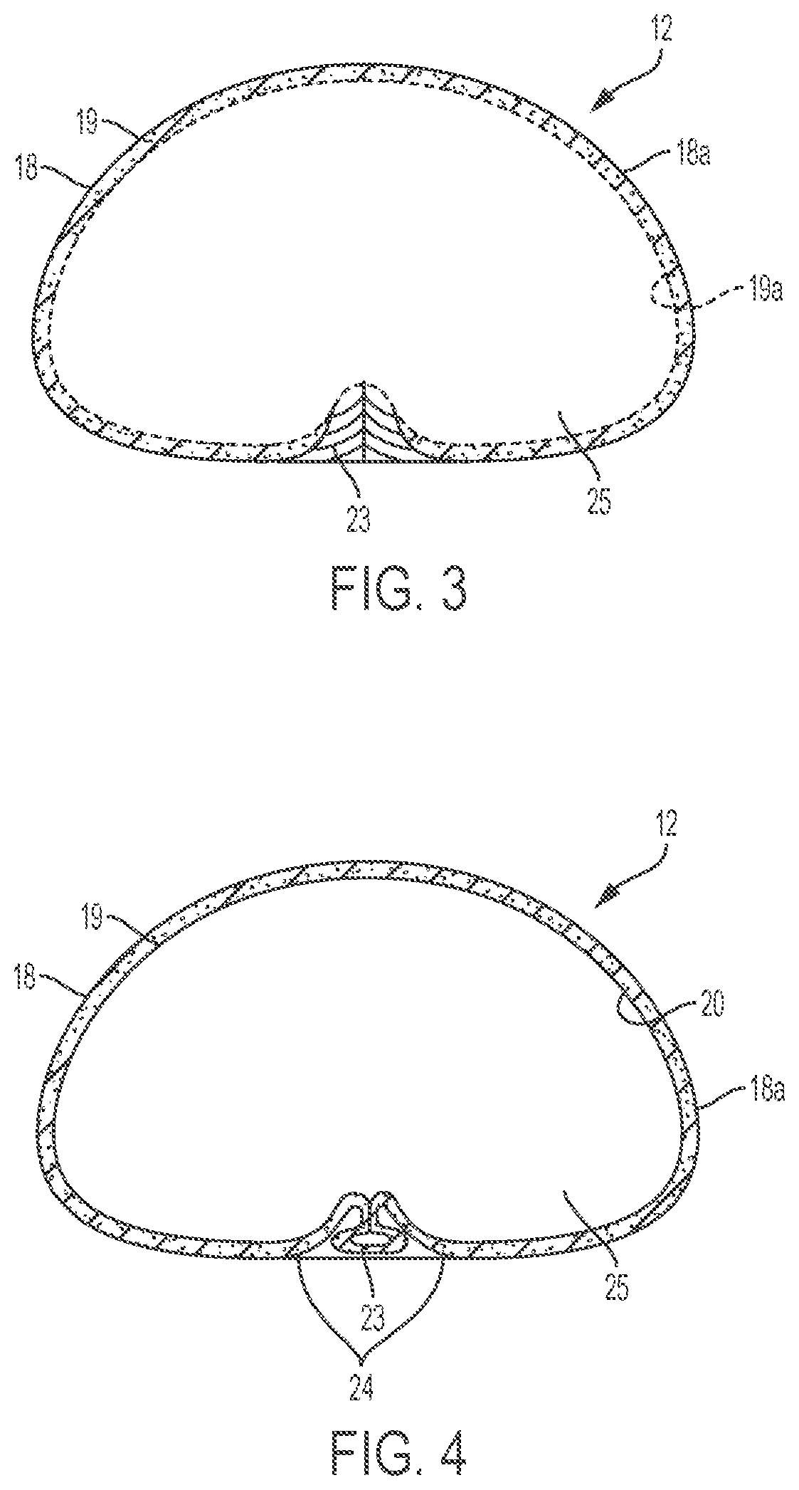 Patent US12303379 Figure 3 – Implant with elastomeric membrane and methods of fabrication thereof
