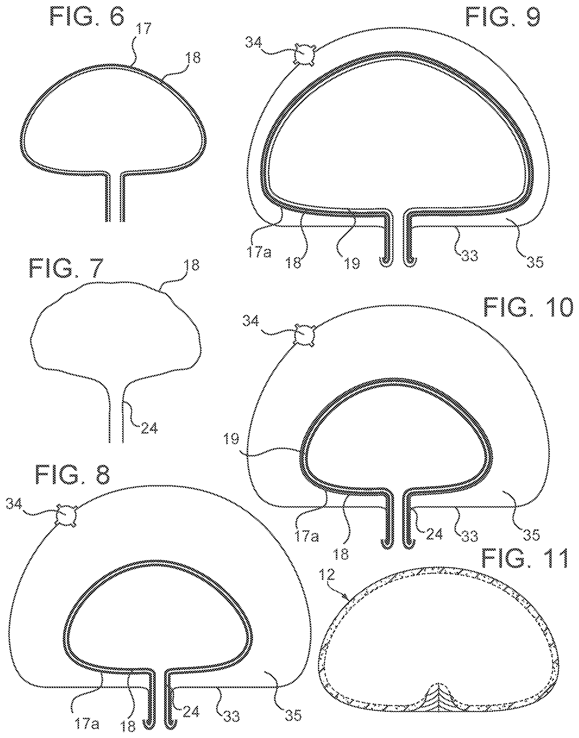 Patent US12303379 Figure 6 – Implant with elastomeric membrane and methods of fabrication thereof