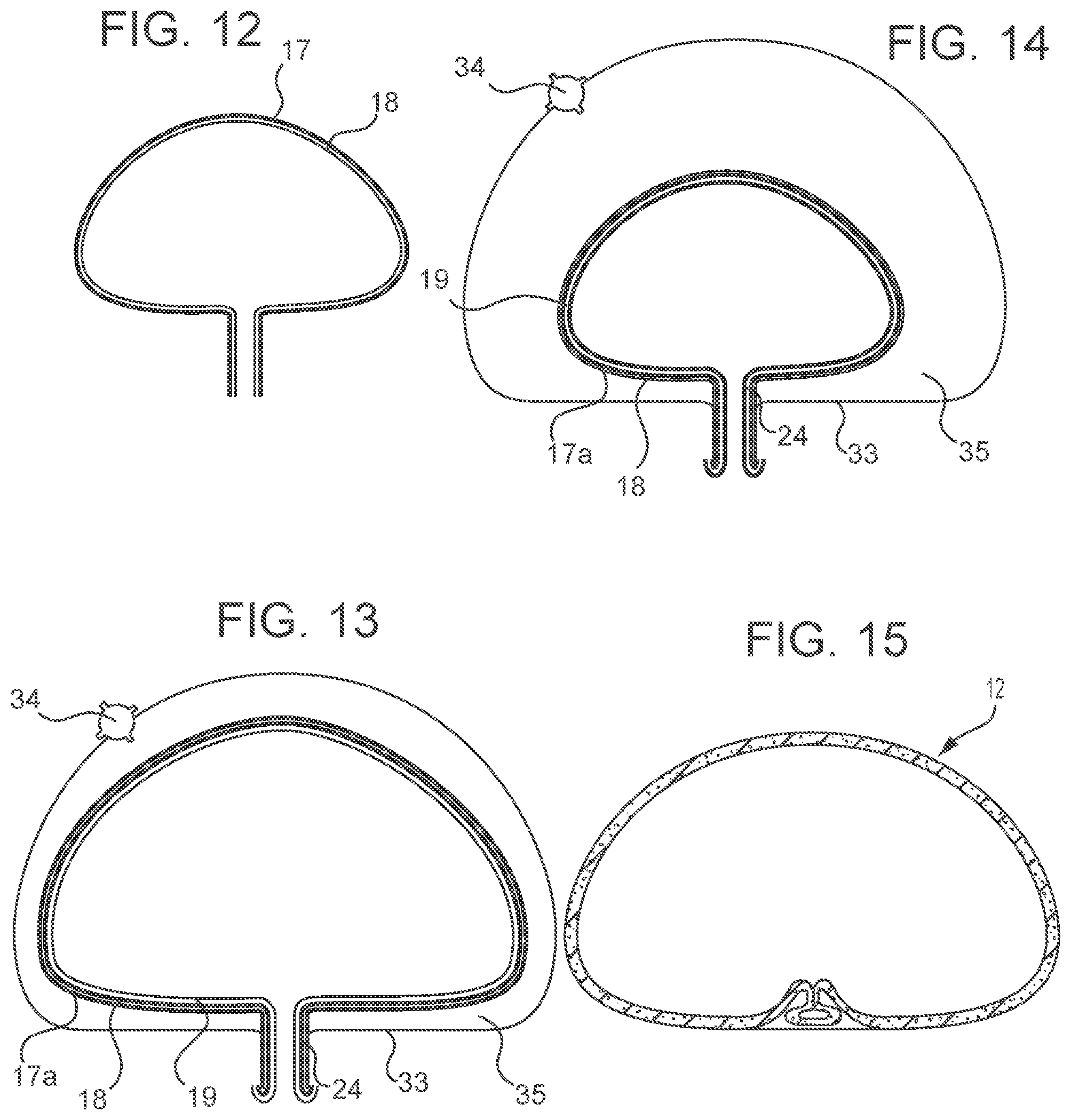 Patent US12303379 Figure 7 – Implant with elastomeric membrane and methods of fabrication thereof