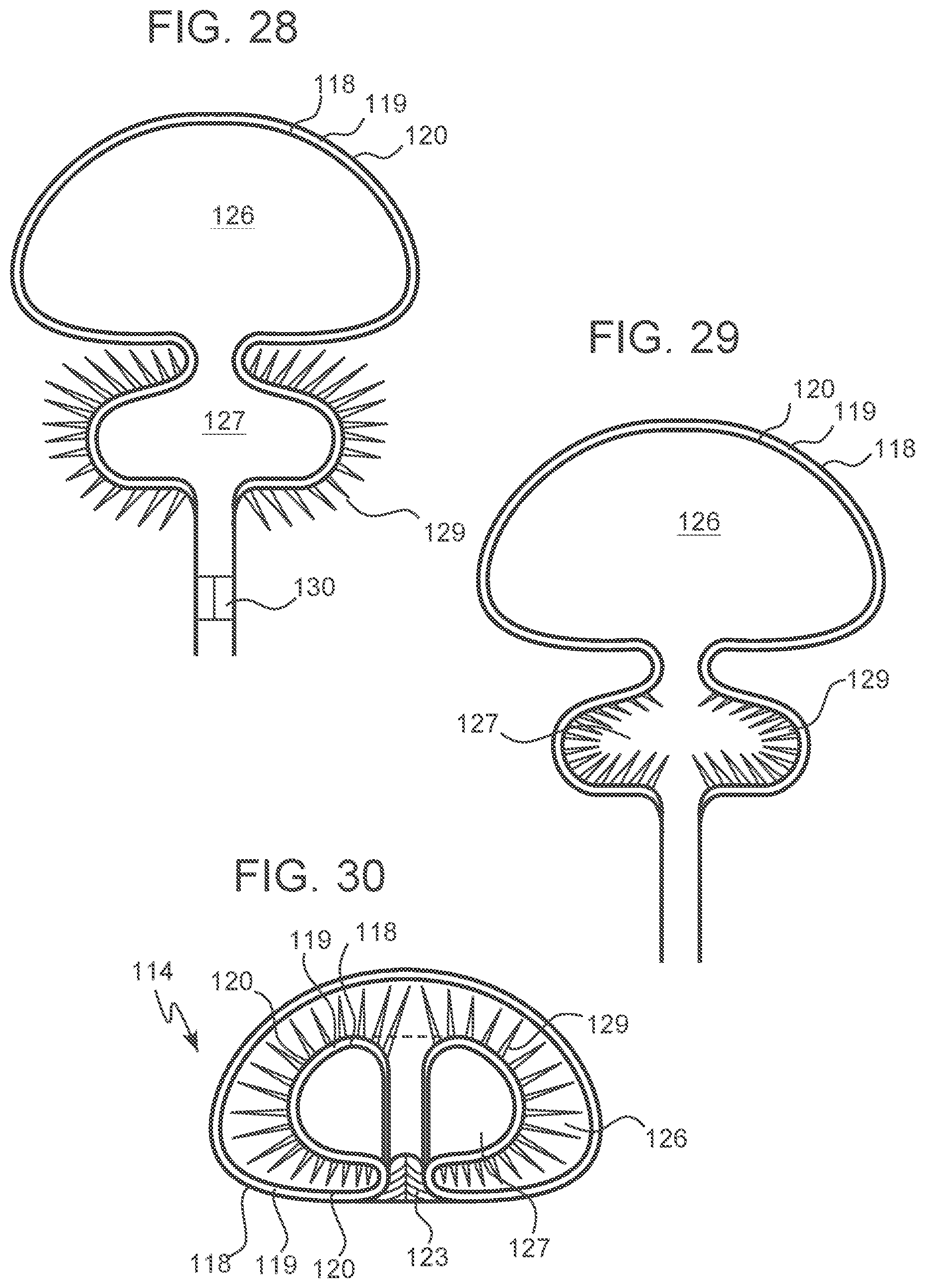 Patent US12303379 Figure 11 – Implant with elastomeric membrane and methods of fabrication thereof