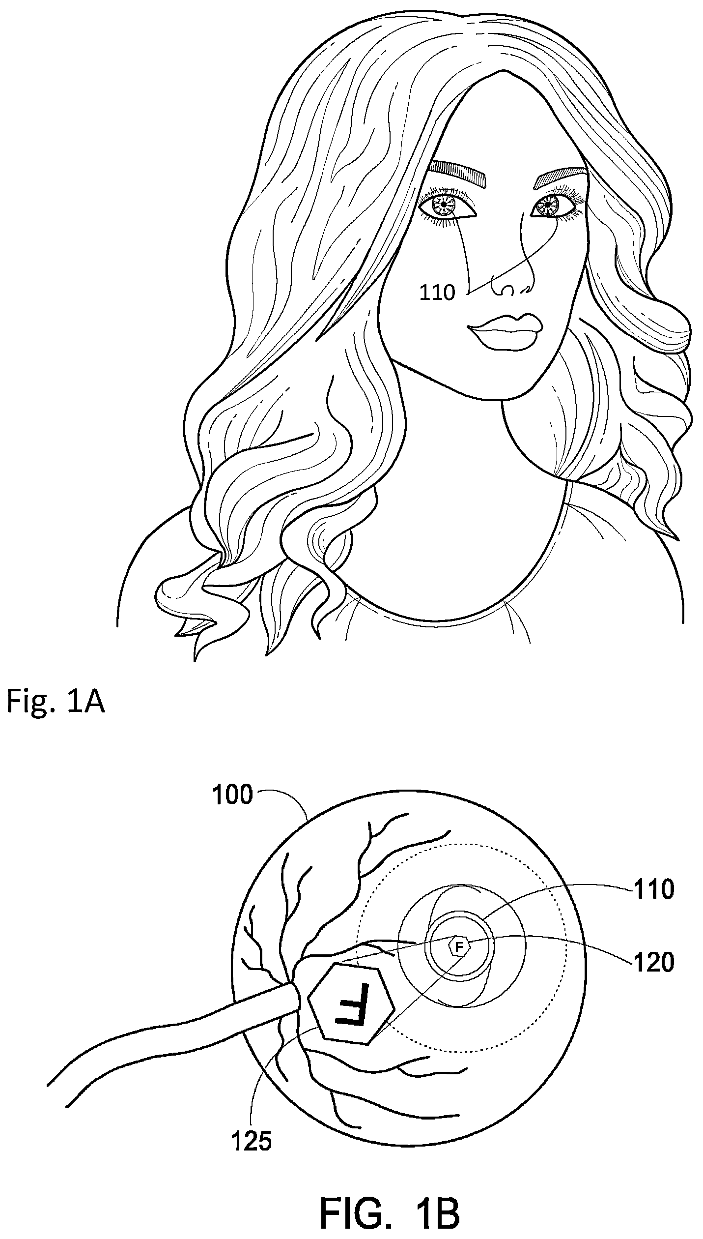 Patent US12303380 Figure 1 – Compensating corneal opacity