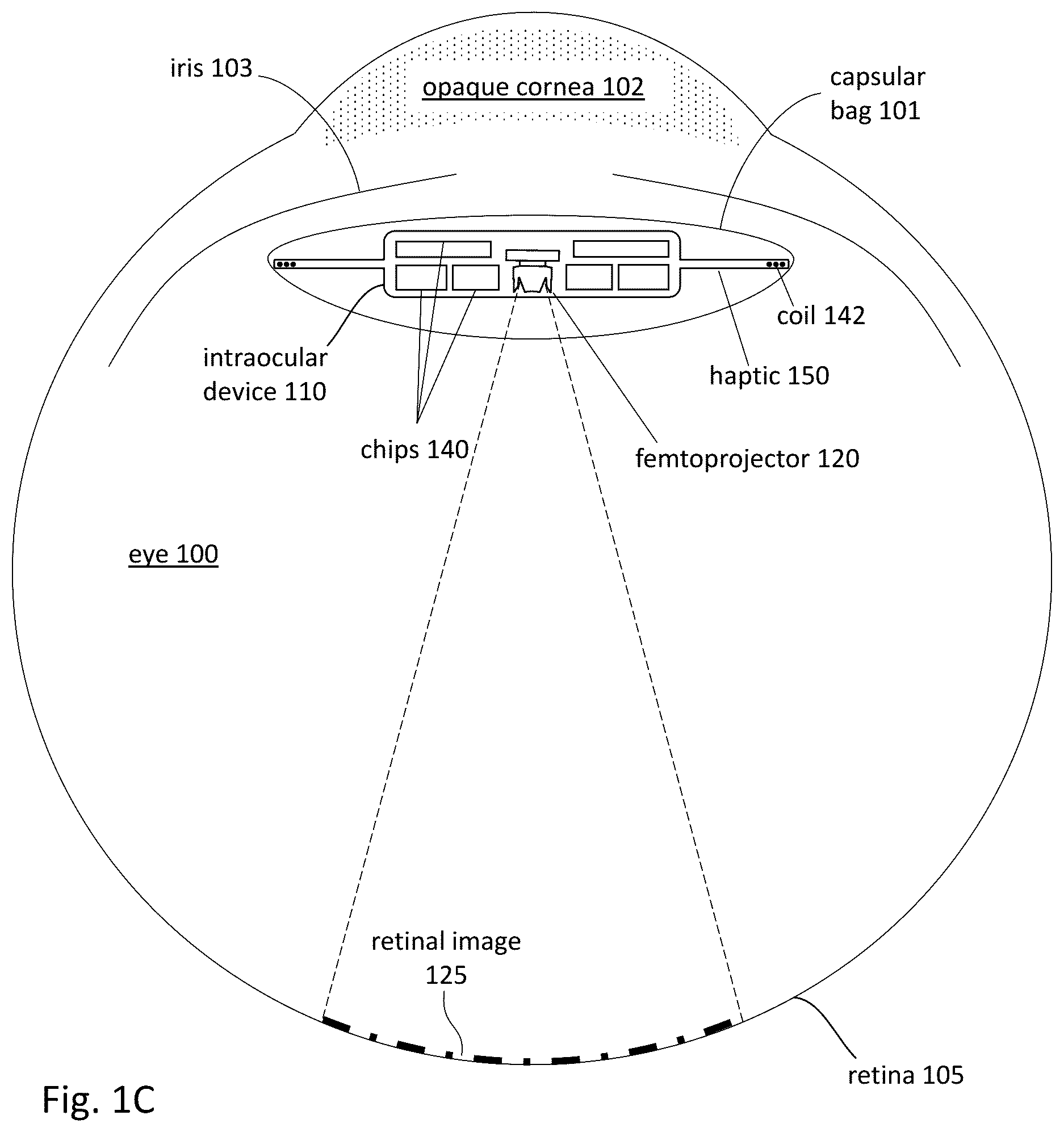 Patent US12303380 Figure 2 – Compensating corneal opacity