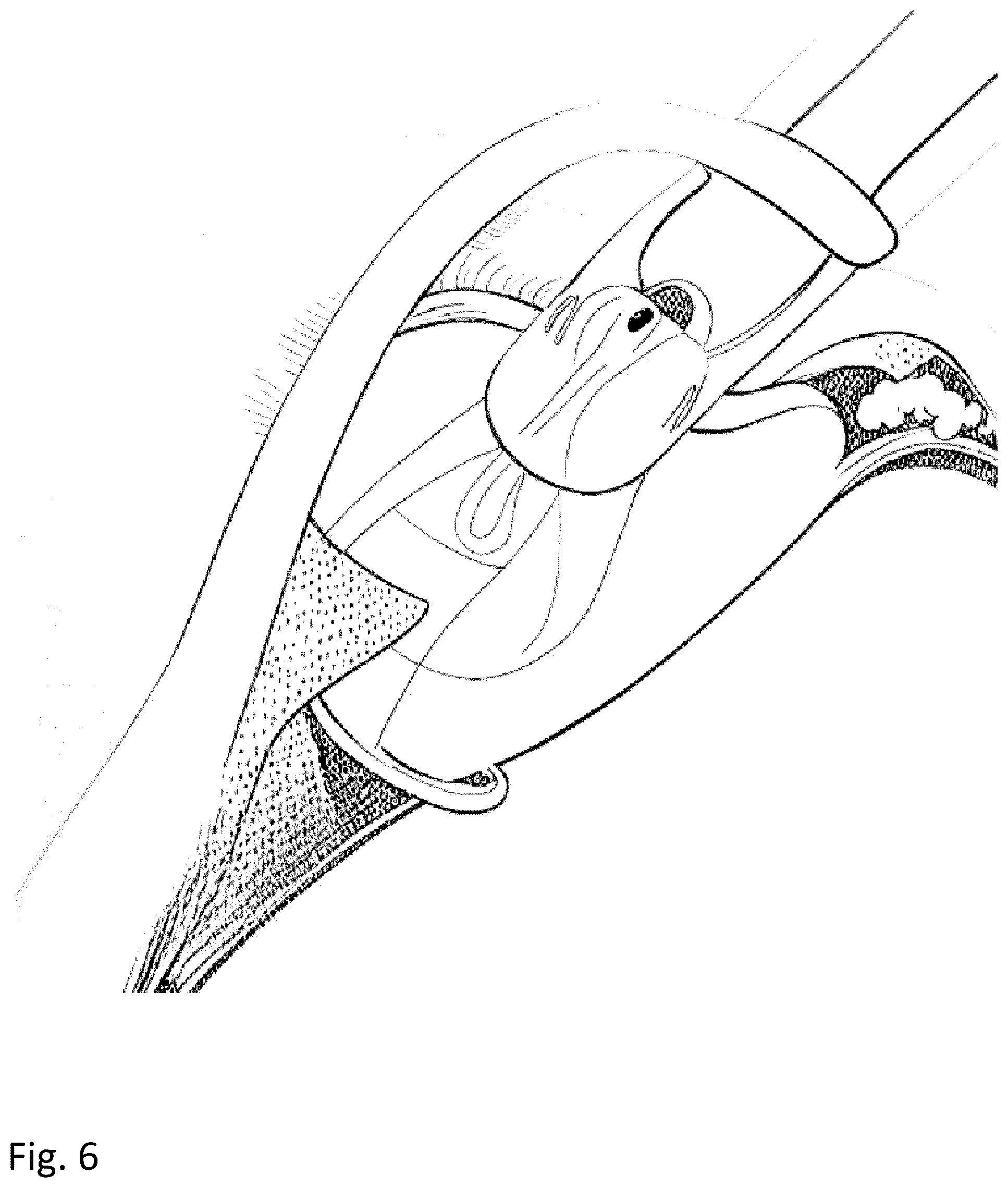 Patent US12303380 Figure 7 – Compensating corneal opacity