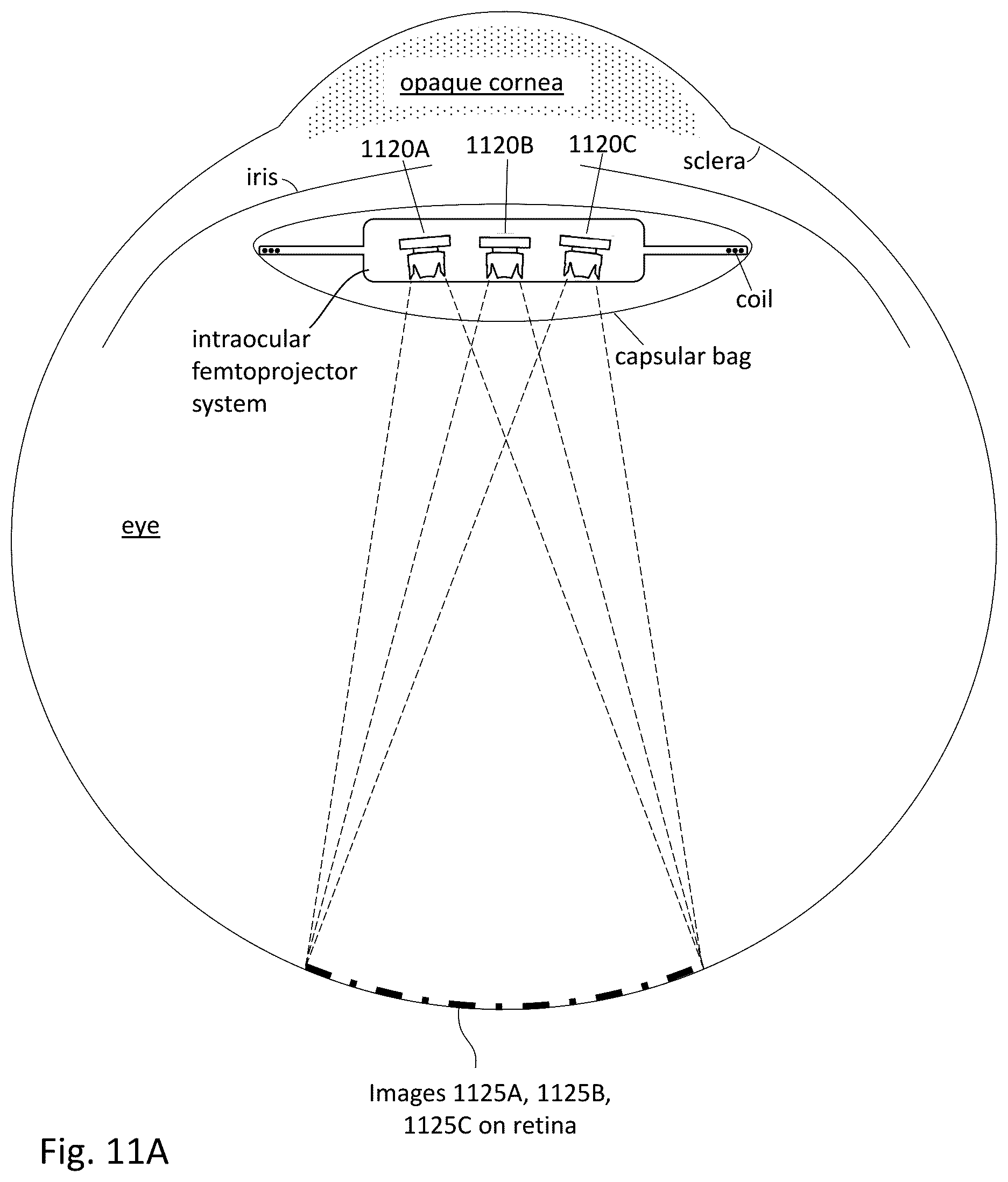 Patent US12303380 Figure 14 – Compensating corneal opacity