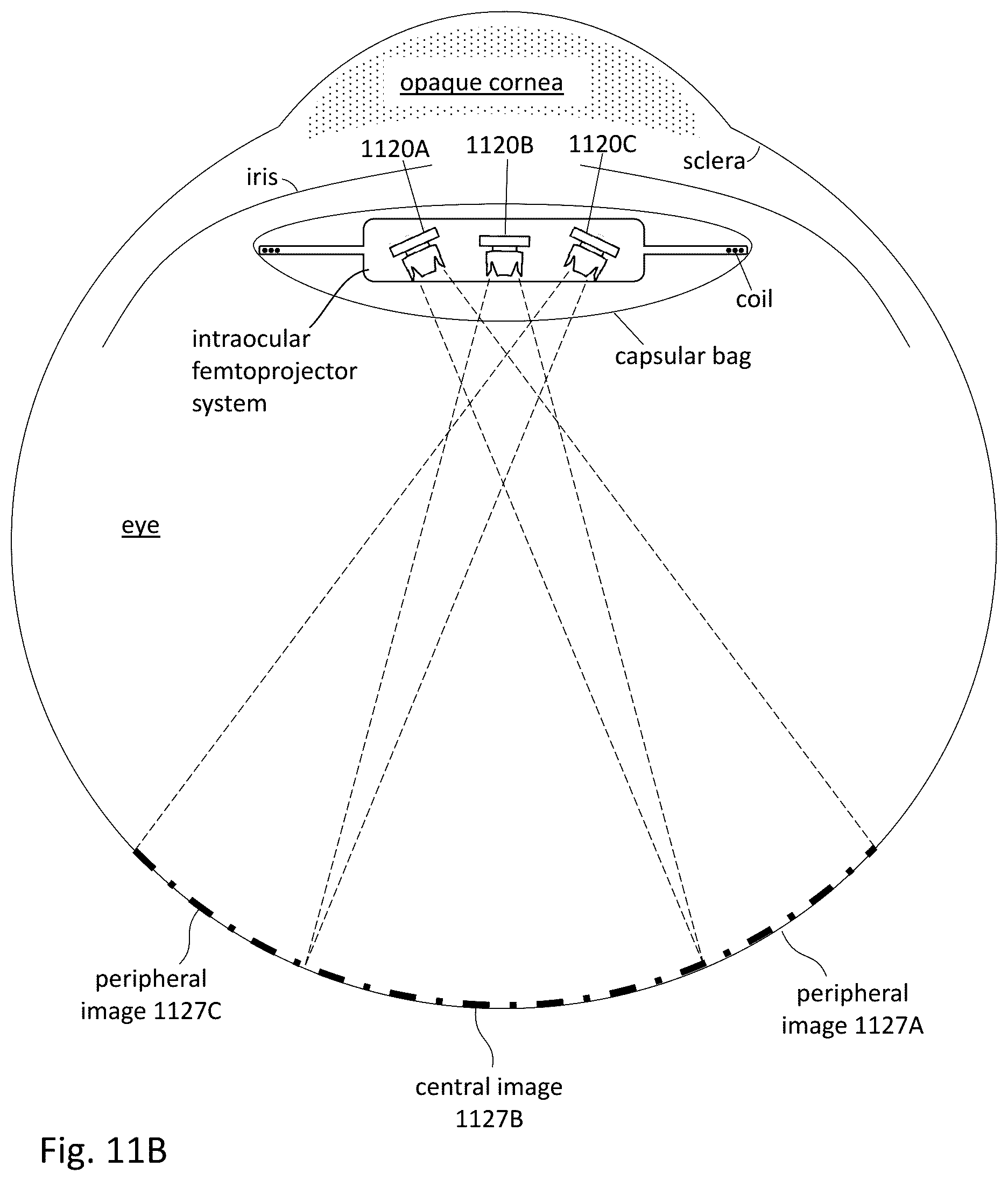 Patent US12303380 Figure 15 – Compensating corneal opacity
