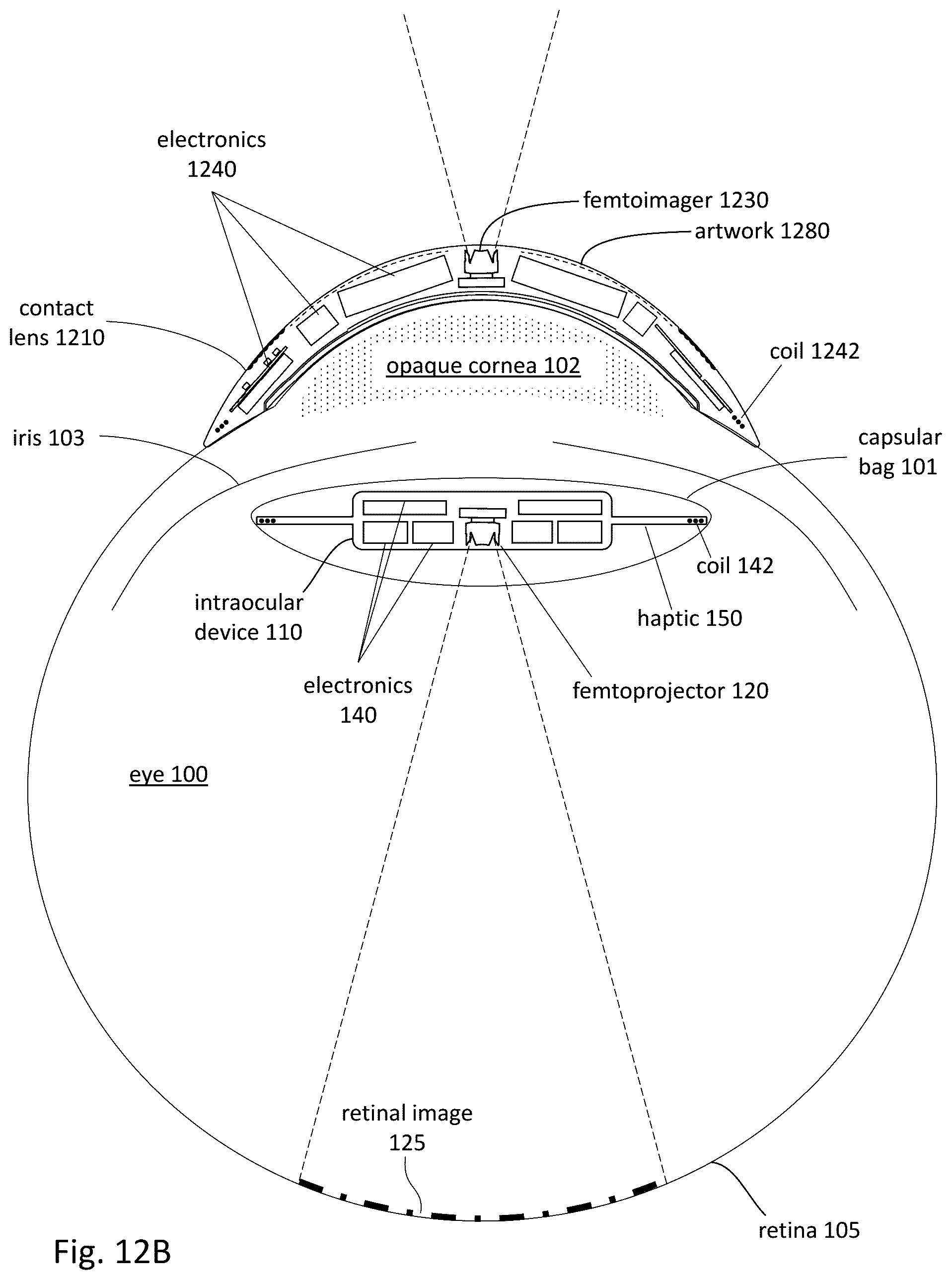 Patent US12303380 Figure 17 – Compensating corneal opacity