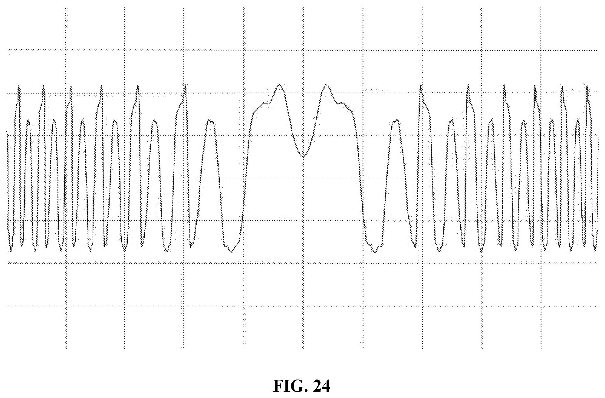 Patent US12303381 Figure 16 – Quint-focal diffractive intraocular lens