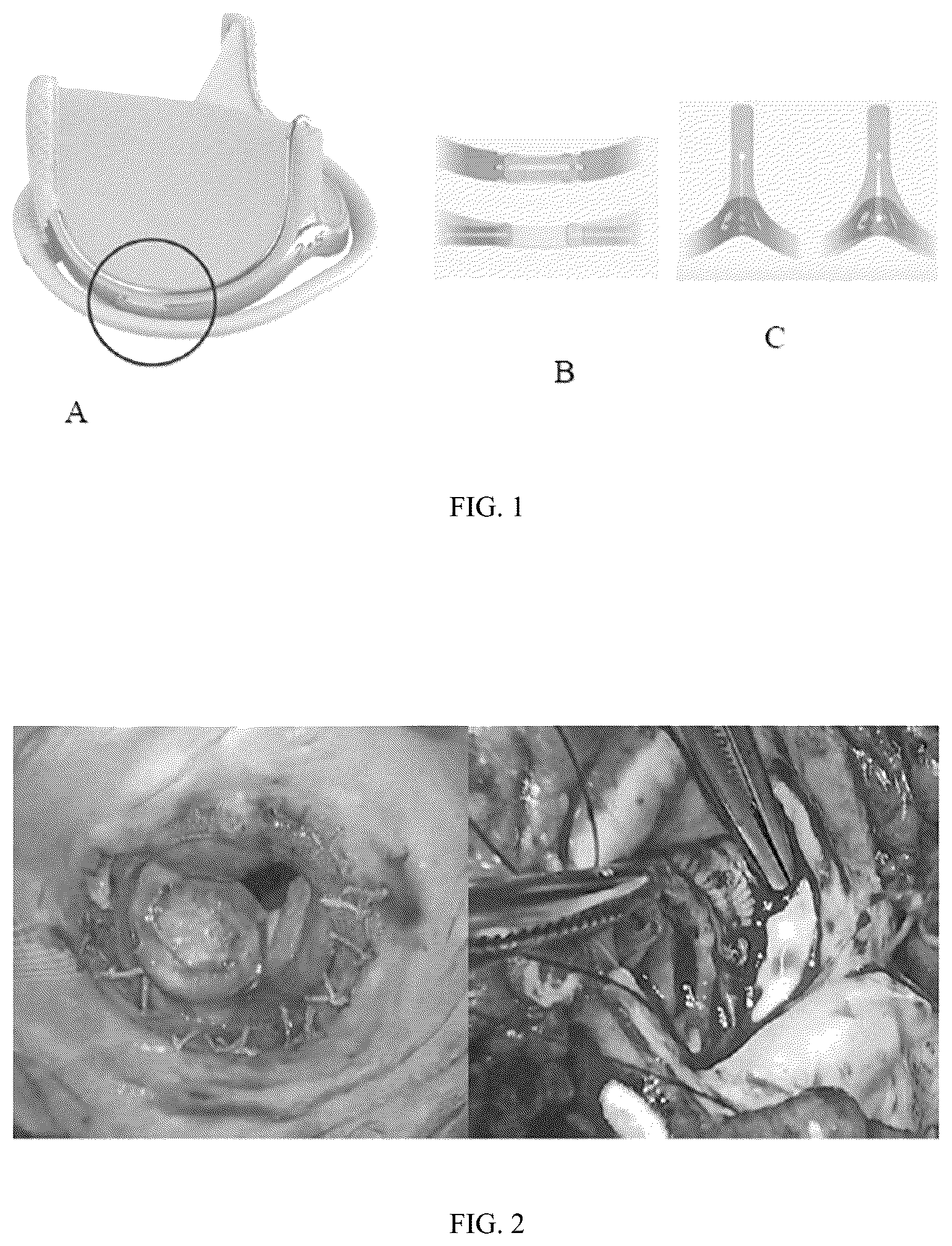 Patent US12303383 Figure 1 – One-way limiting expandable artificial biological heart valve