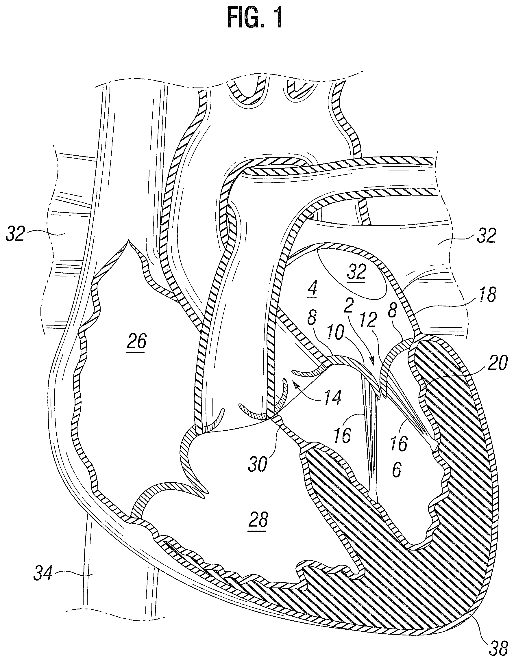 Patent US12303385 — Method of implanting a spacer body in a mitral valve — Figure 1