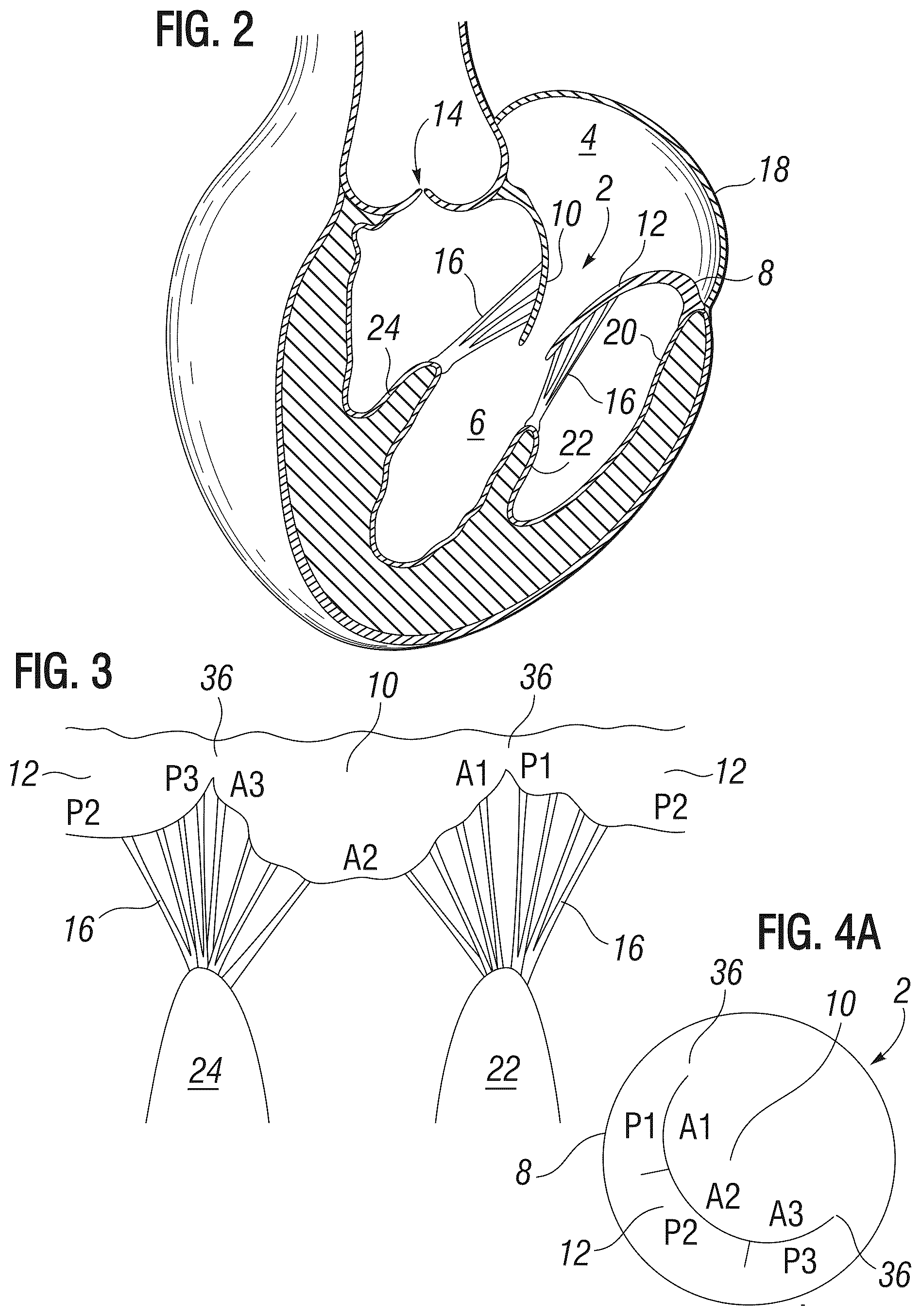 Patent US12303385 Figure 2 – Method of implanting a spacer body in a mitral valve