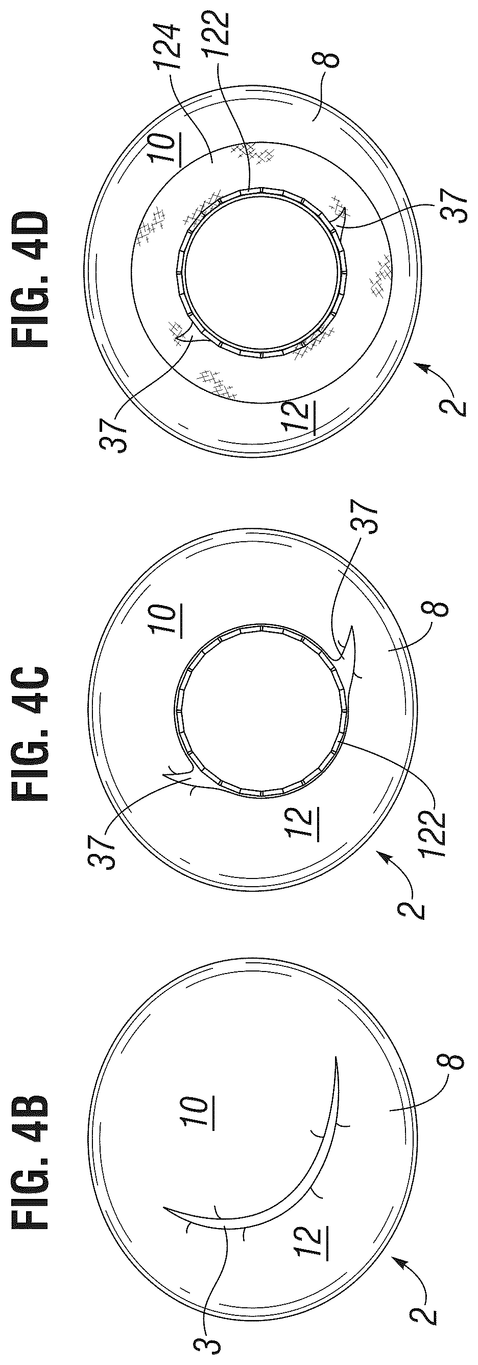 Patent US12303385 Figure 3 – Method of implanting a spacer body in a mitral valve