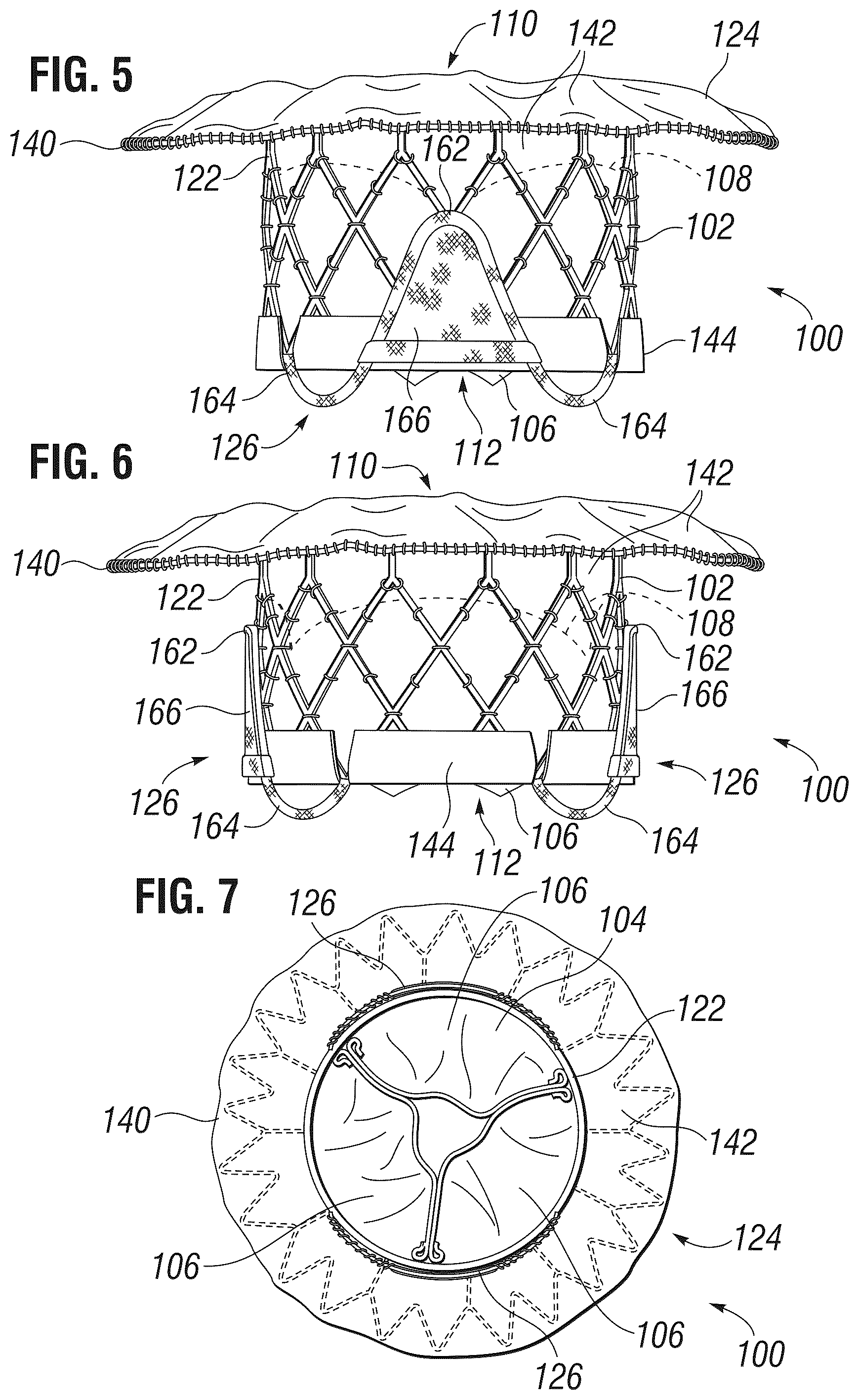 Patent US12303385 Figure 4 – Method of implanting a spacer body in a mitral valve