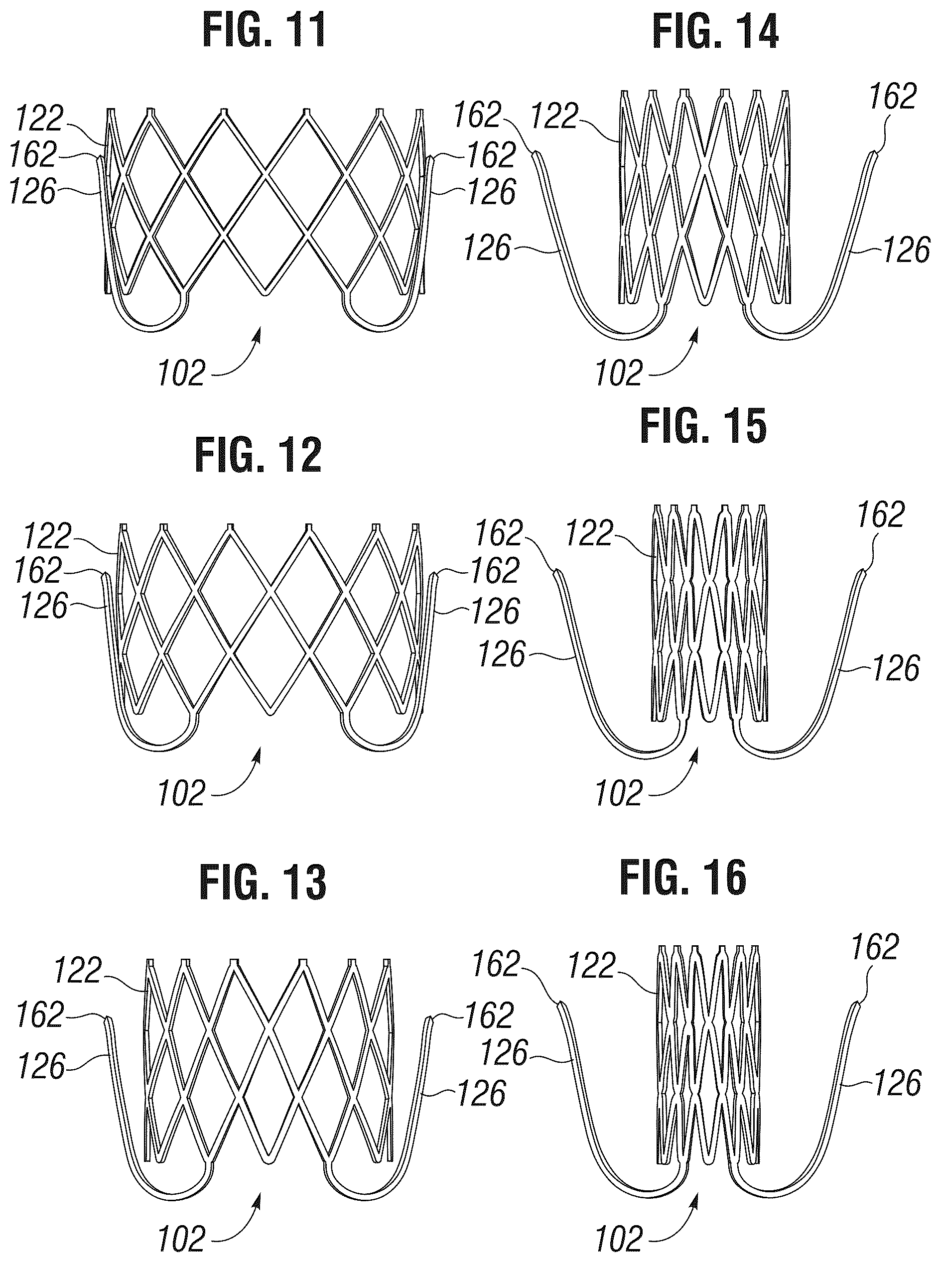 Patent US12303385 Figure 6 – Method of implanting a spacer body in a mitral valve