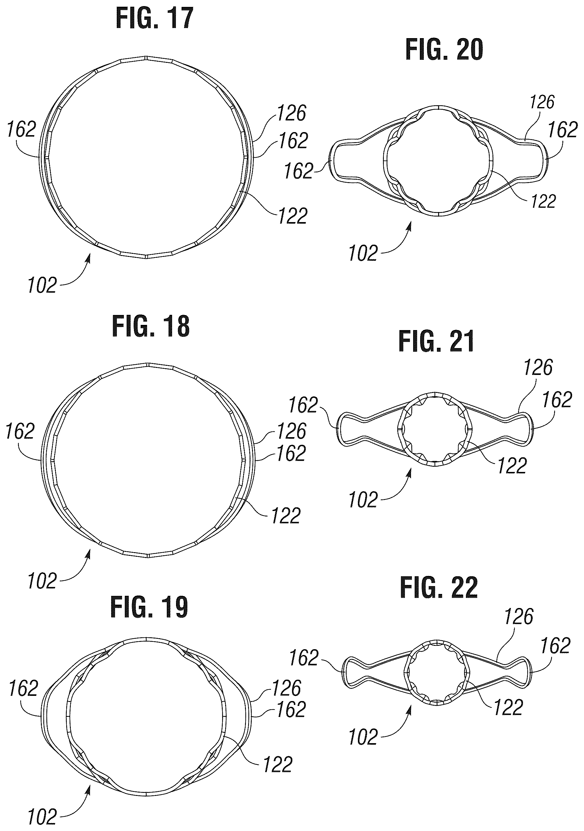 Patent US12303385 Figure 7 – Method of implanting a spacer body in a mitral valve