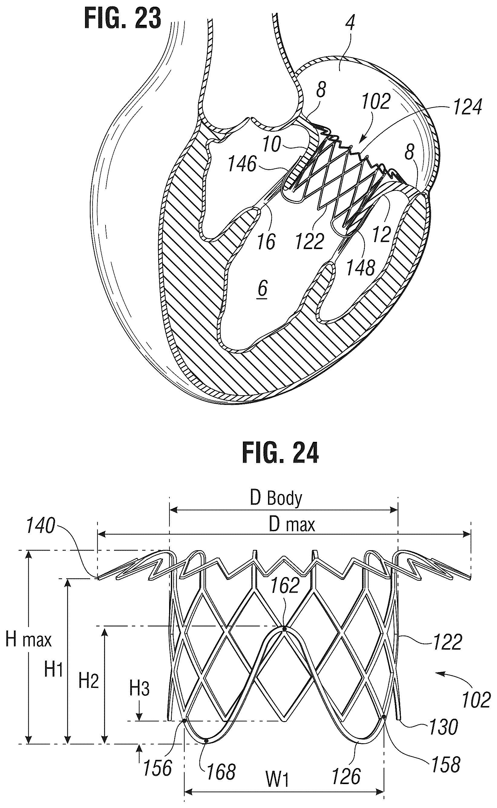 Patent US12303385 Figure 8 – Method of implanting a spacer body in a mitral valve