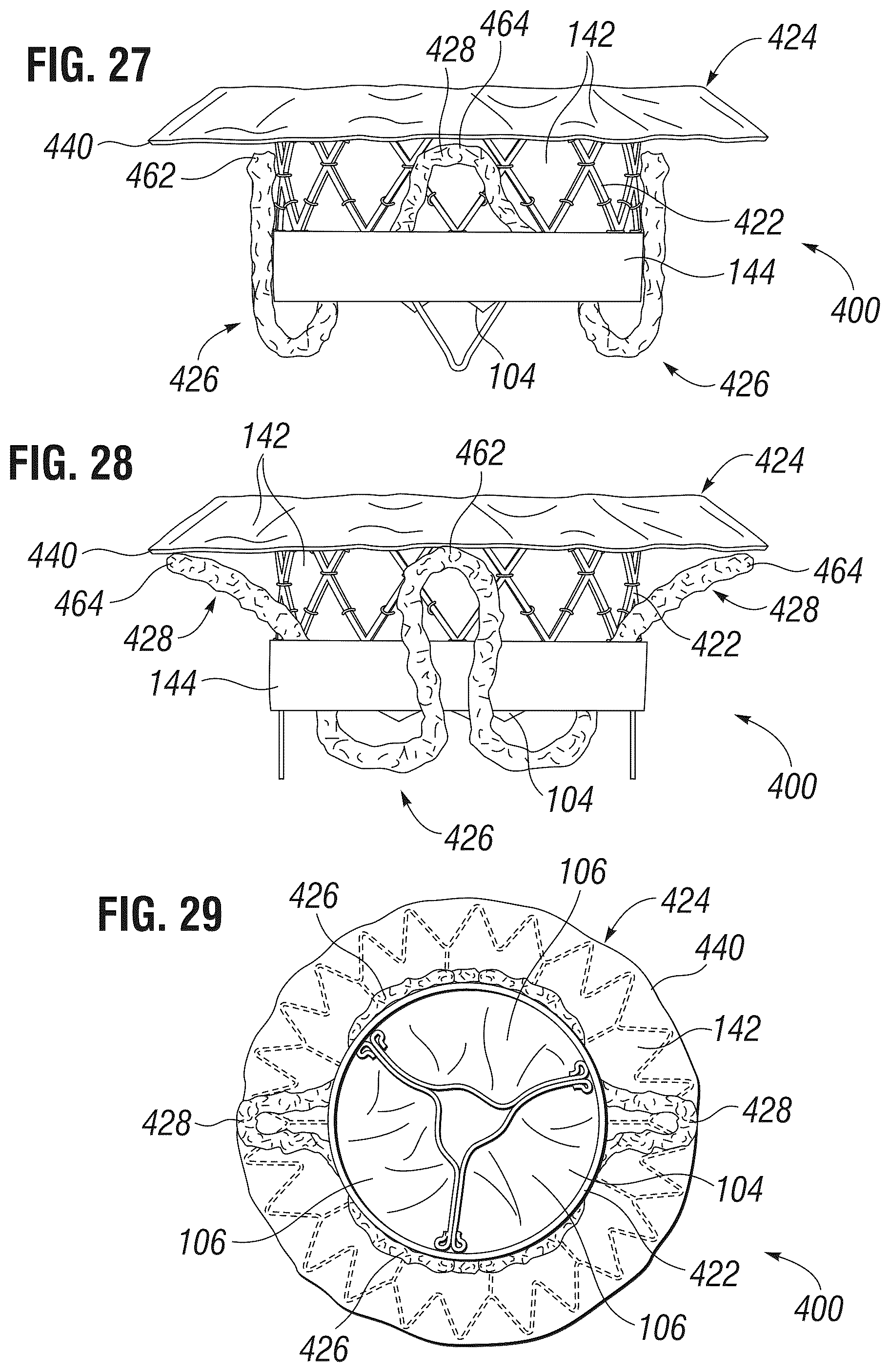 Patent US12303385 Figure 10 – Method of implanting a spacer body in a mitral valve