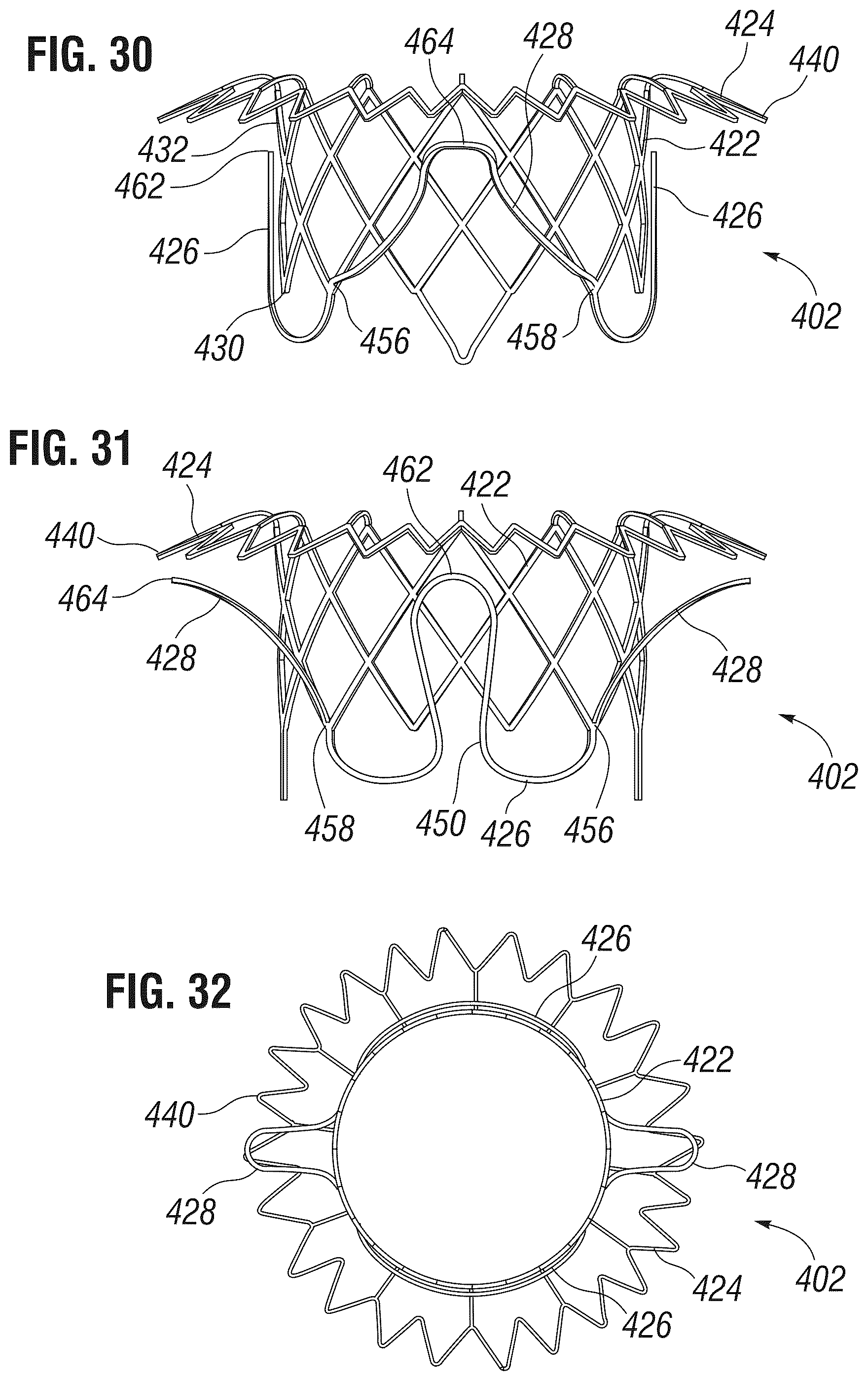 Patent US12303385 Figure 11 – Method of implanting a spacer body in a mitral valve