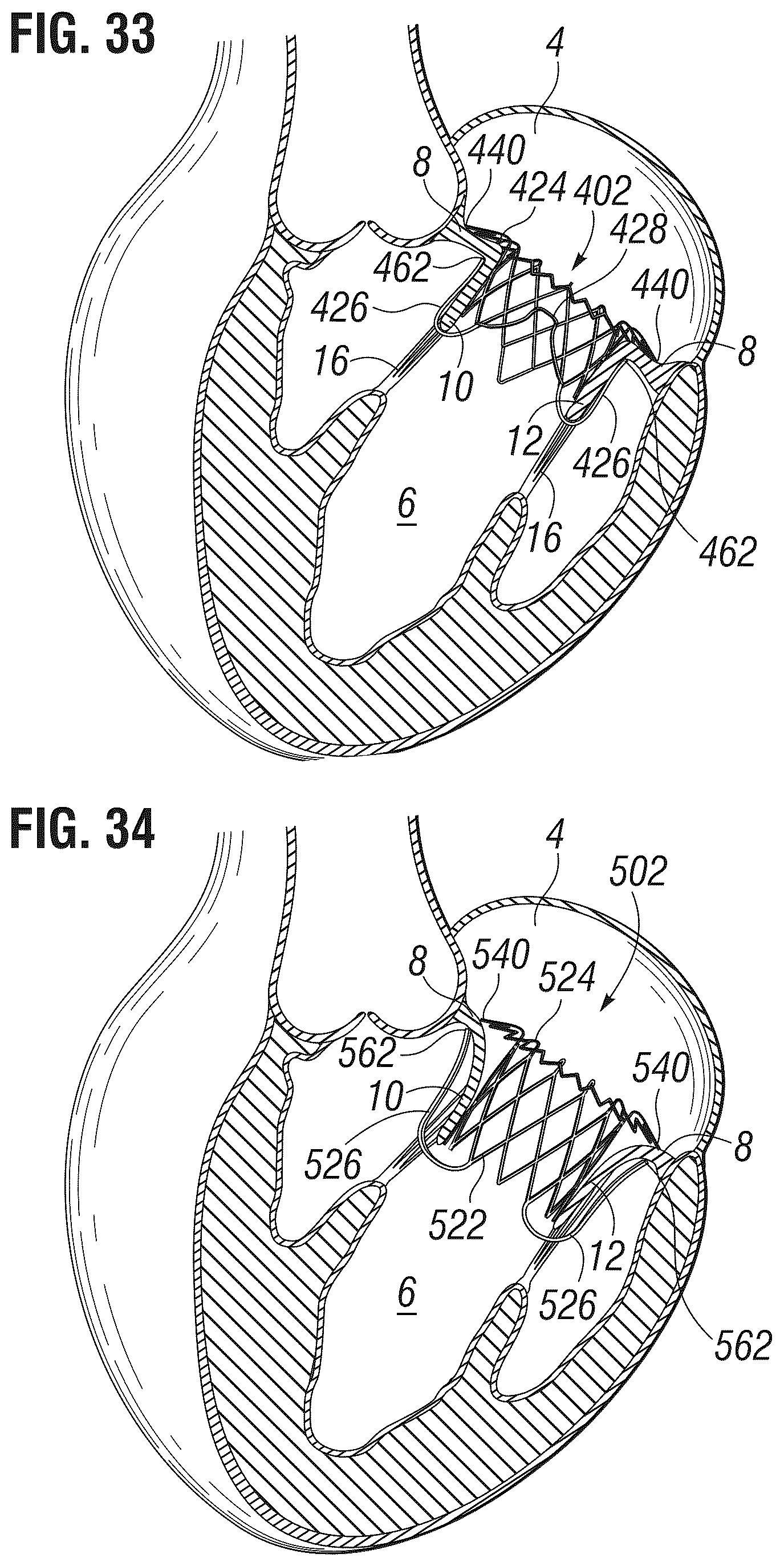 Patent US12303385 Figure 12 – Method of implanting a spacer body in a mitral valve