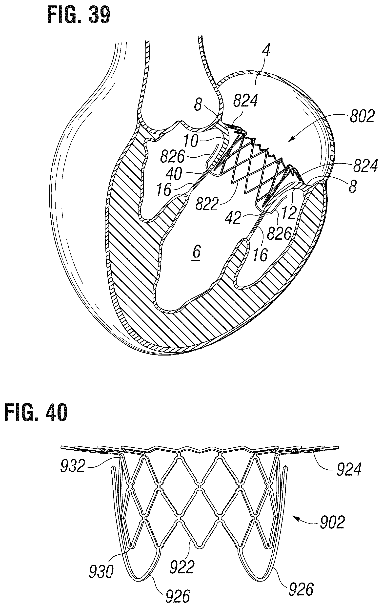 Patent US12303385 Figure 15 – Method of implanting a spacer body in a mitral valve