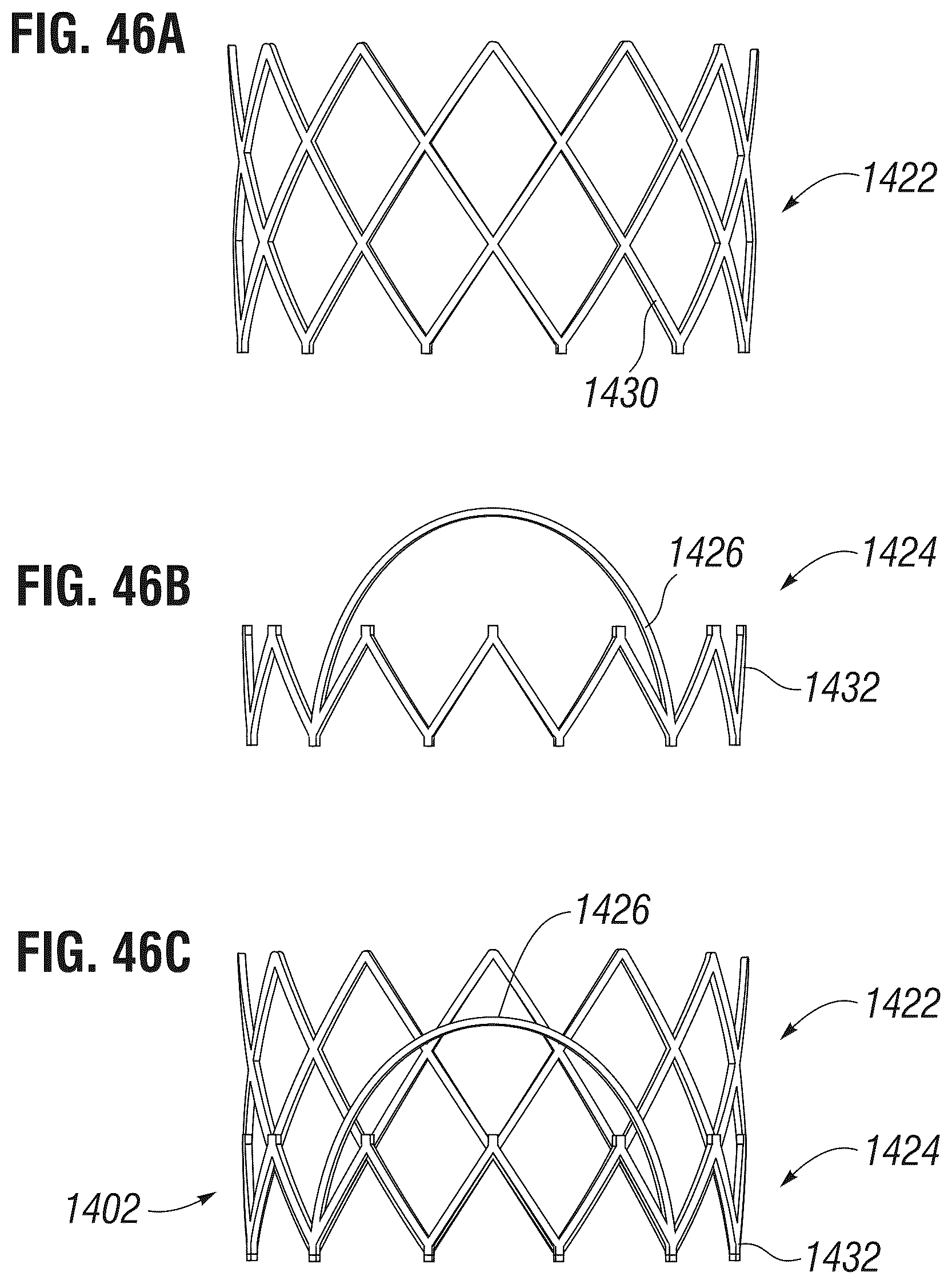 Patent US12303385 Figure 18 – Method of implanting a spacer body in a mitral valve