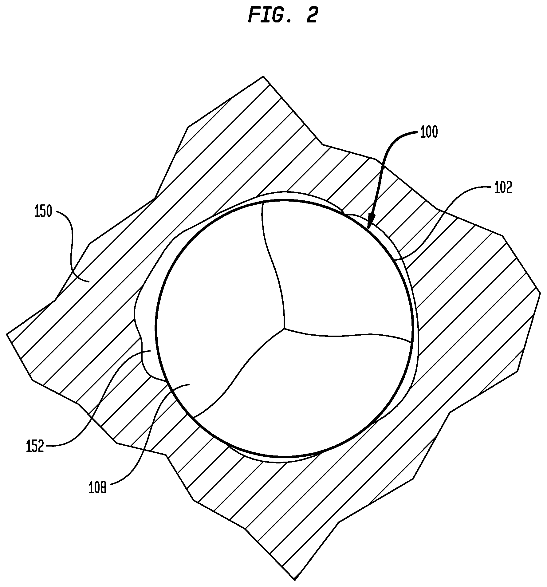 Patent US12303386 Figure 2 – Stent assembly for use in prosthetic heart valves
