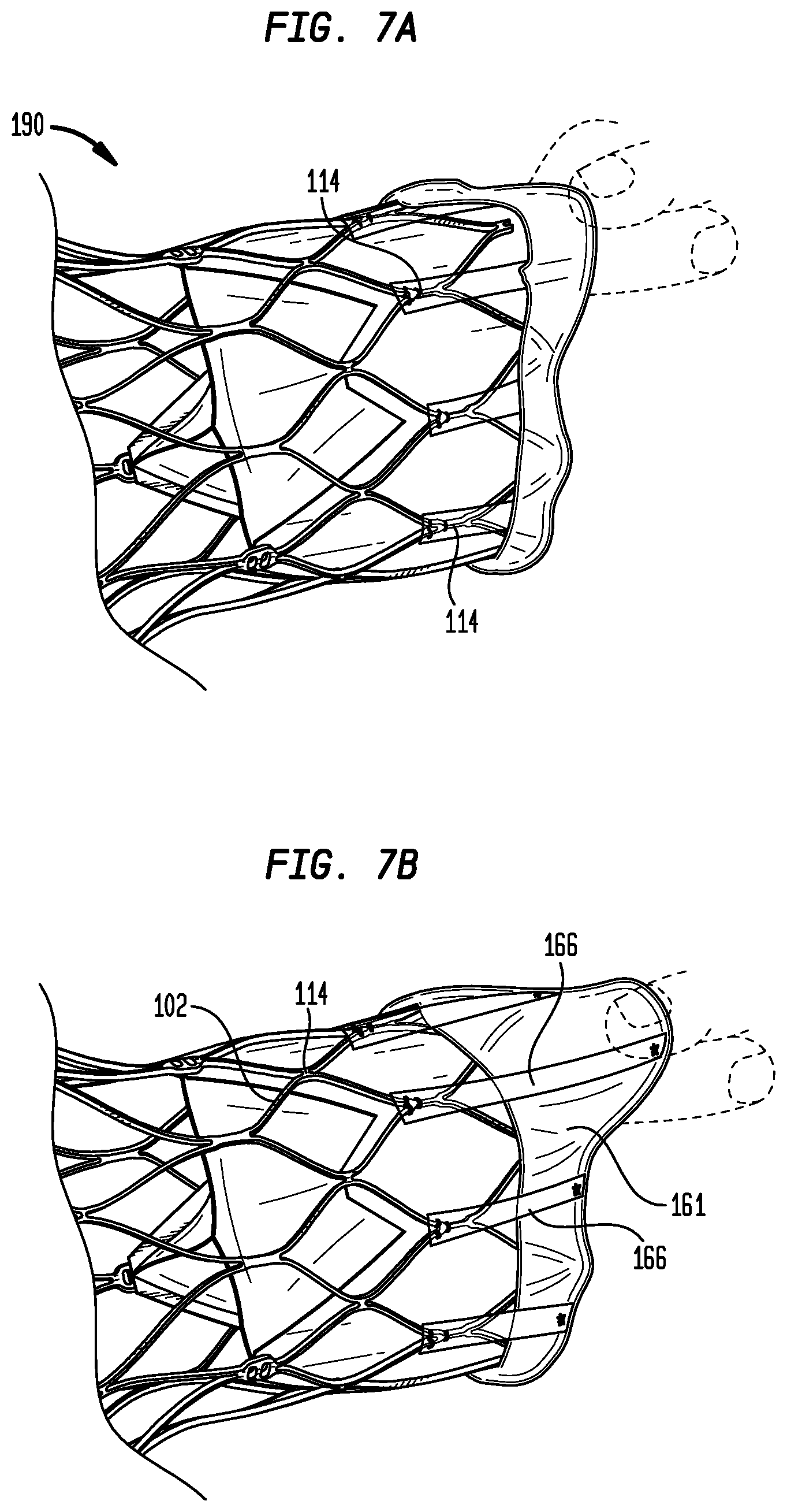 Patent US12303386 Figure 5 – Stent assembly for use in prosthetic heart valves