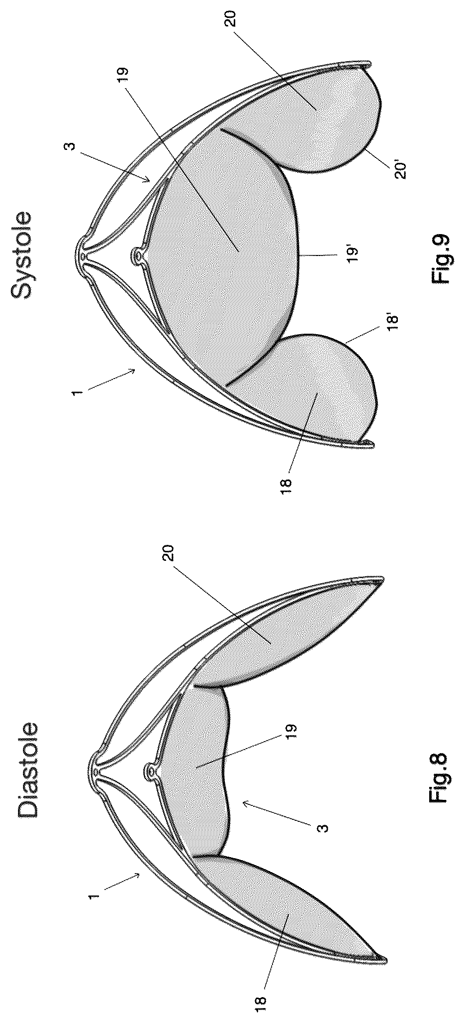 Patent US12303387 Figure 5 – Implant for improving coaptation of an atrioventricular valve